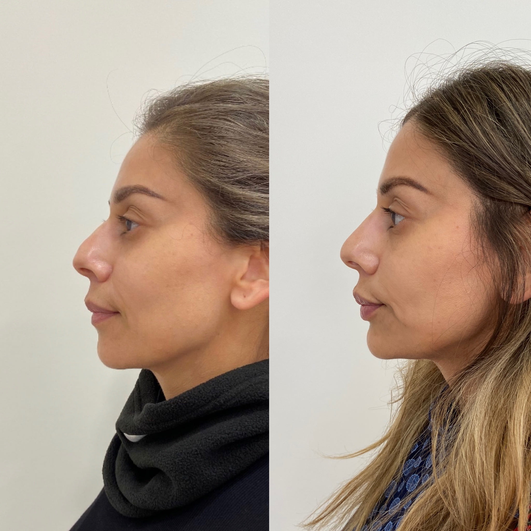 Before and After Fillers treatment on Nose | Beauty Boost Med Spa at Newport Beach, CA