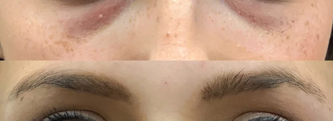 The Magic of PRP: Before And After | Beauty Boost Med Spa