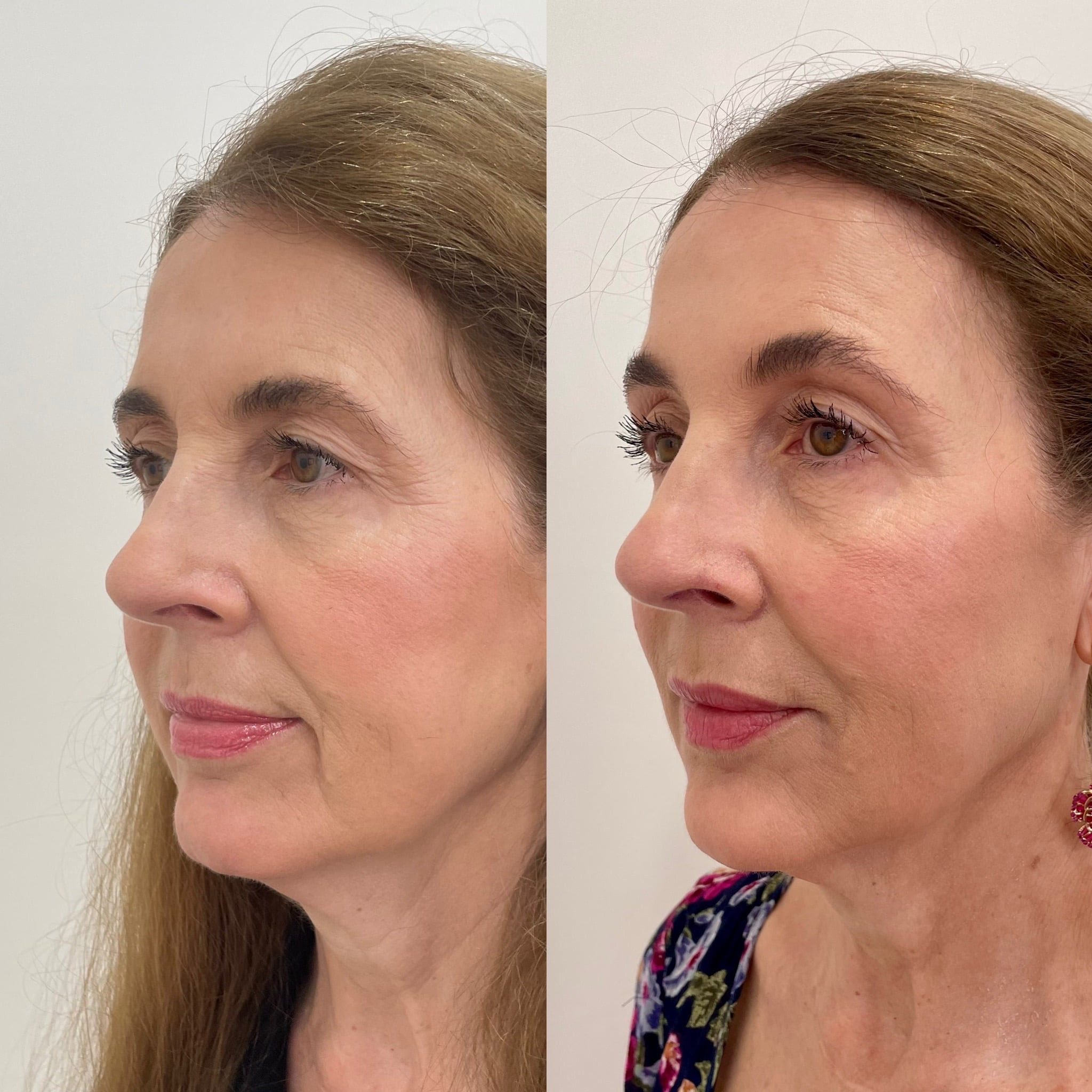 Before and After Fillers Temples treatment | Beauty Boost Med Spa at Newport Beach, CA