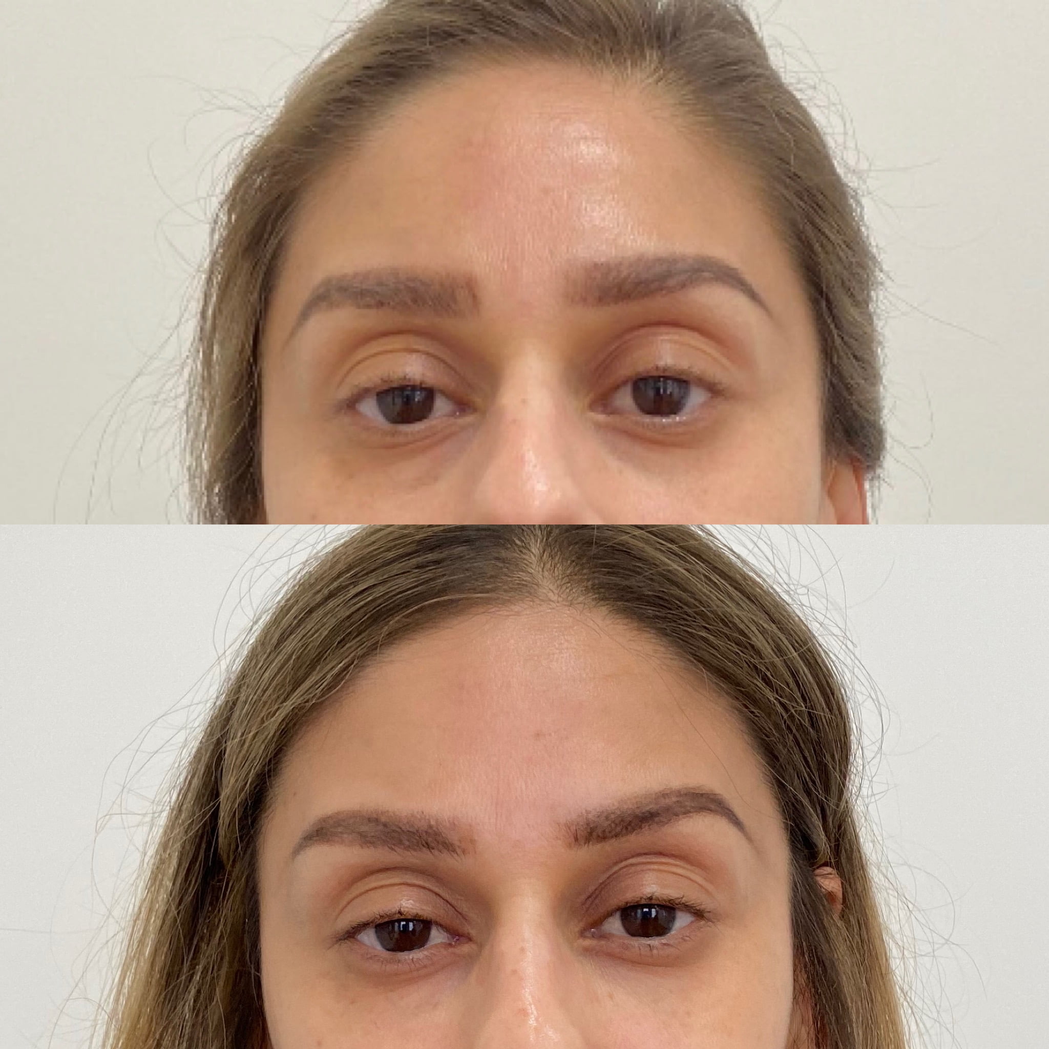 Before and After Undereyes treatment | Beauty Boost Med Spa at Newport Beach, CA