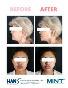 Before and After PDO Thread Lift | Beauty Boost Med Spa at Newport Beach, CA