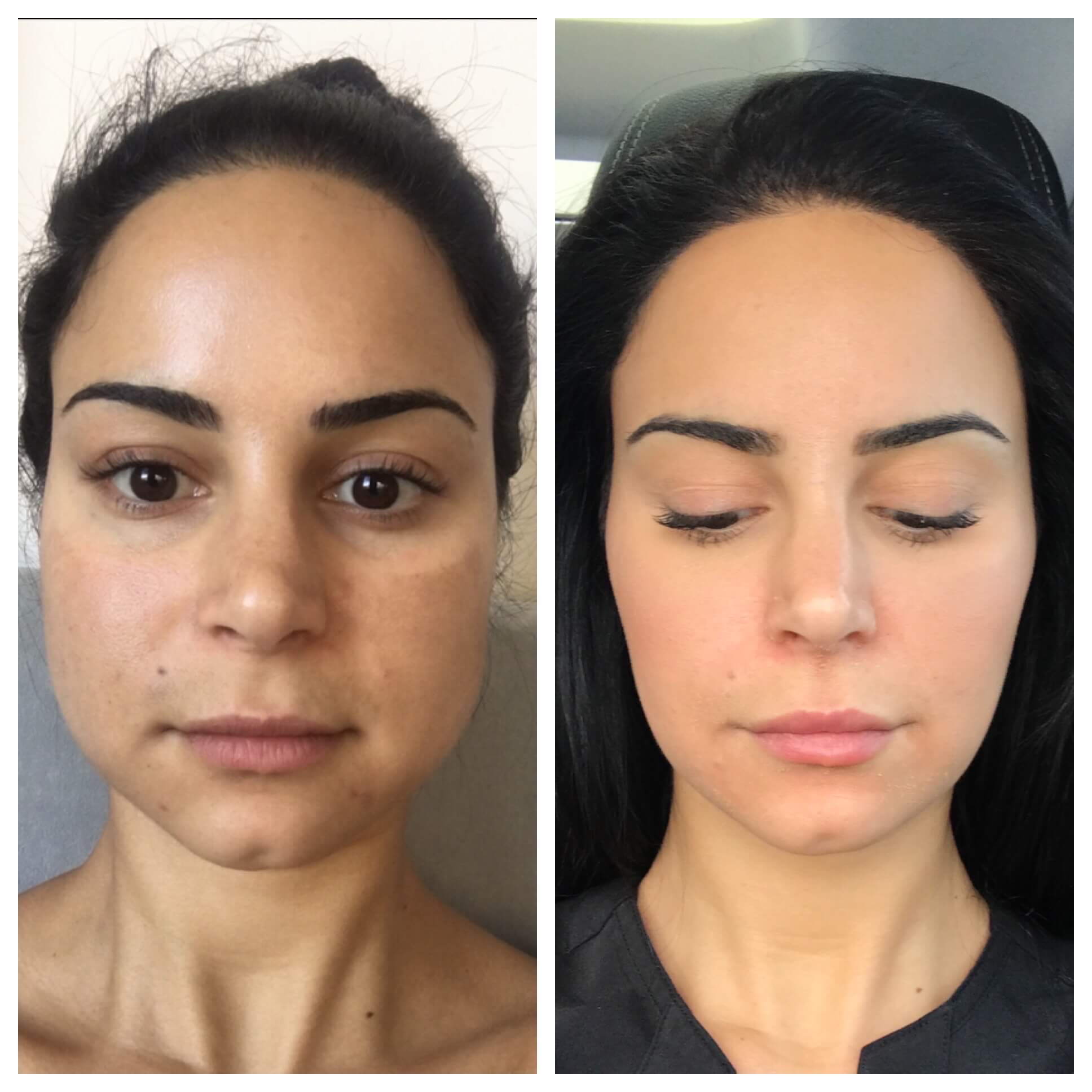 Before and After Three step Peel Treatment | Beauty Boost Med Spa in Newport Beach, CA