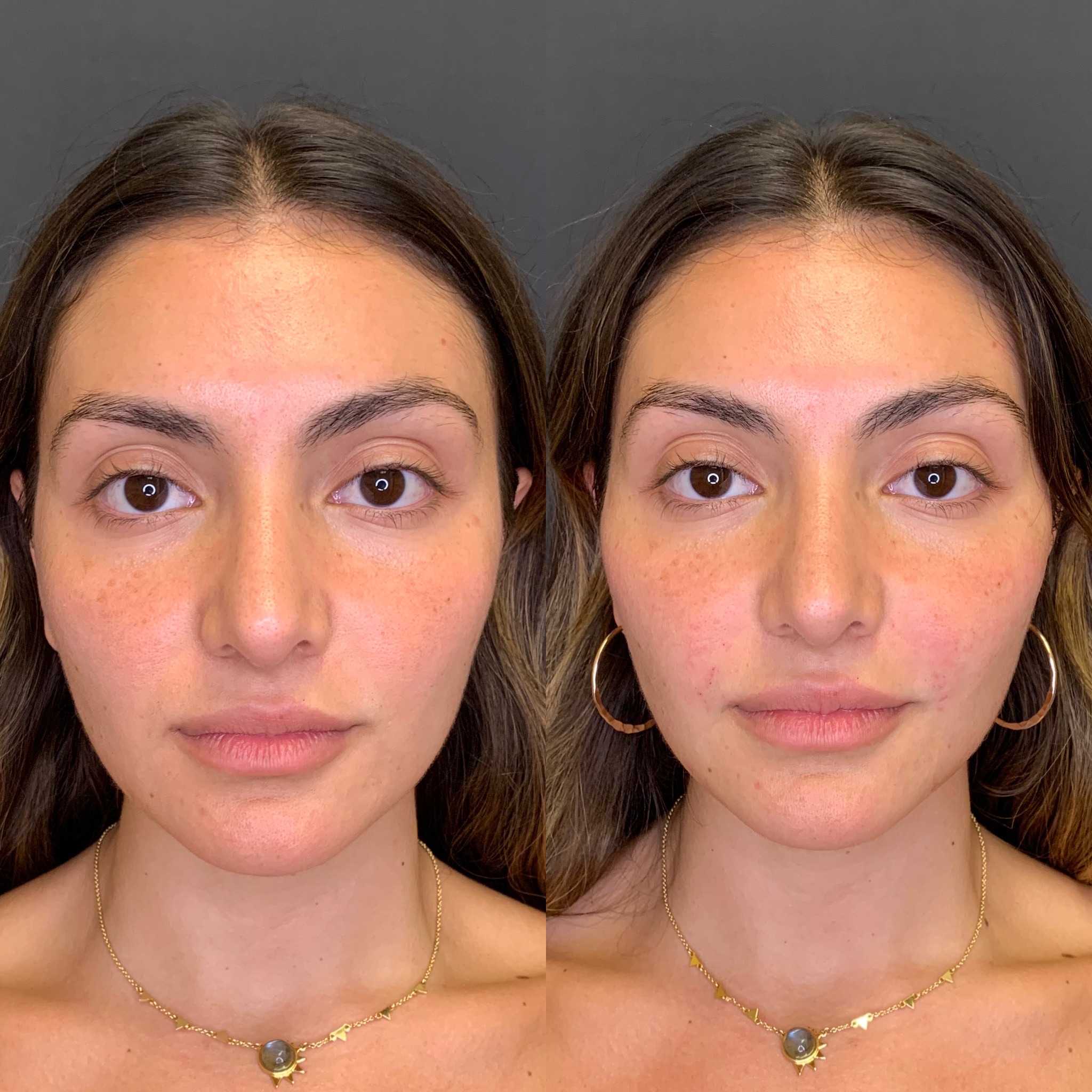 Before and After Cheeks | Beauty Boost Med Spa in Newport Beach, CA