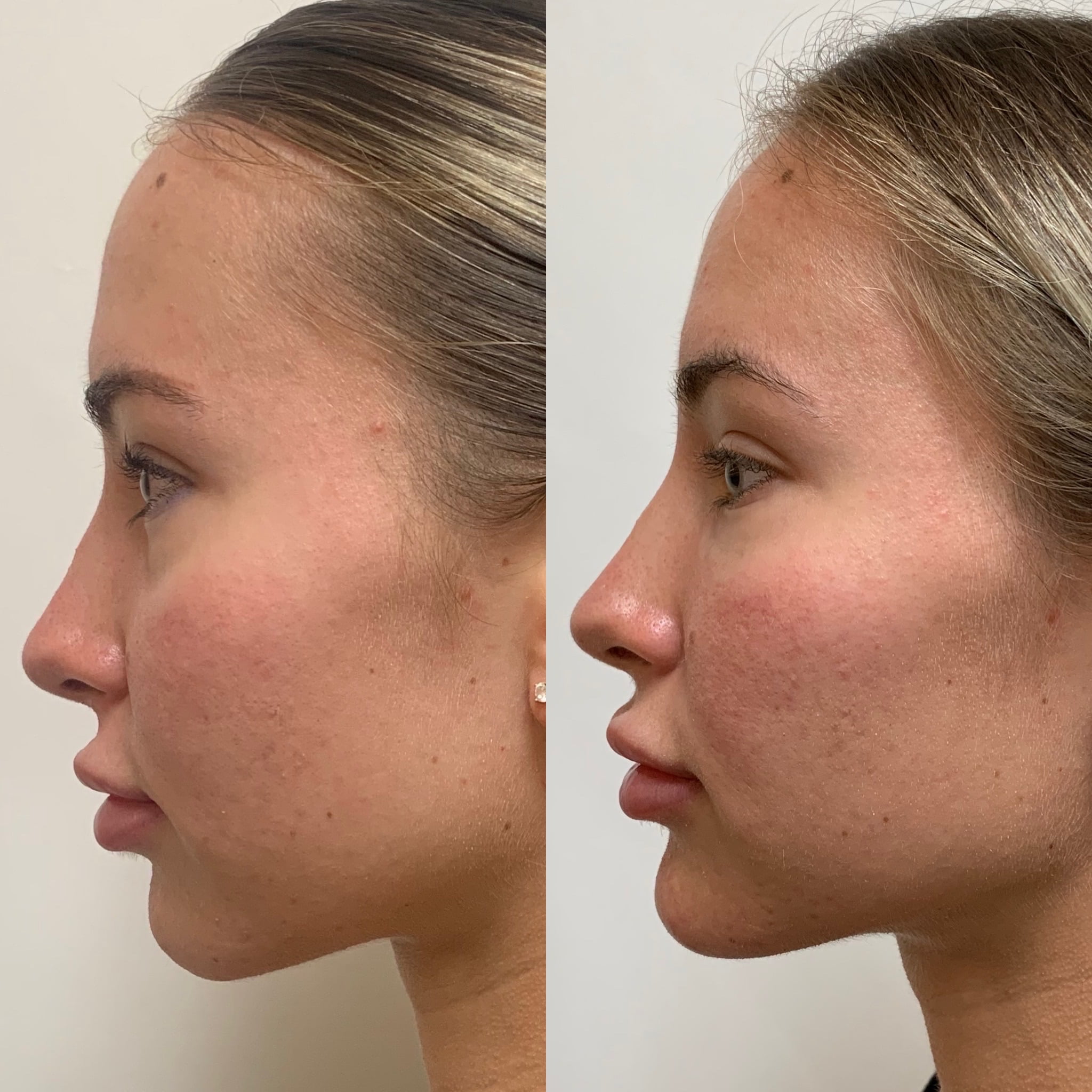 Before and After treatment results on Chin | Beauty Boost Med Spa in Newport Beach, CA