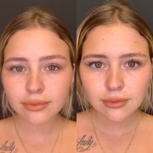 Before and After Fillers Jawline Treatment | Beauty Boost Med Spa in Newport Beach, CA