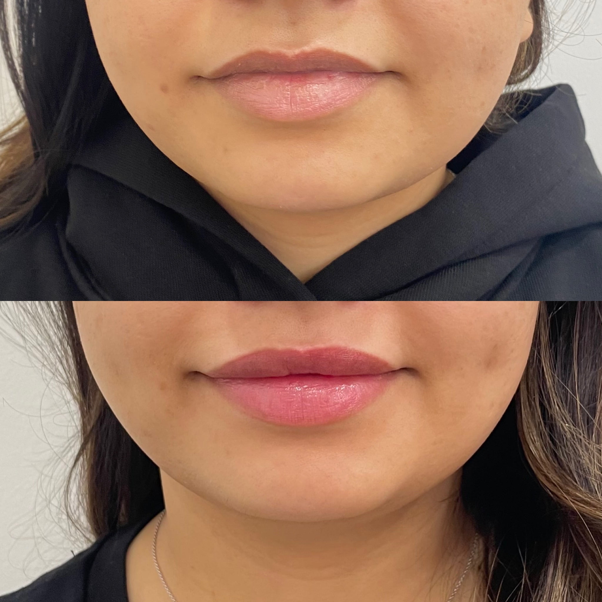 Before and After Lip boost Treatment | Beauty Boost Med Spa in Newport Beach, CA