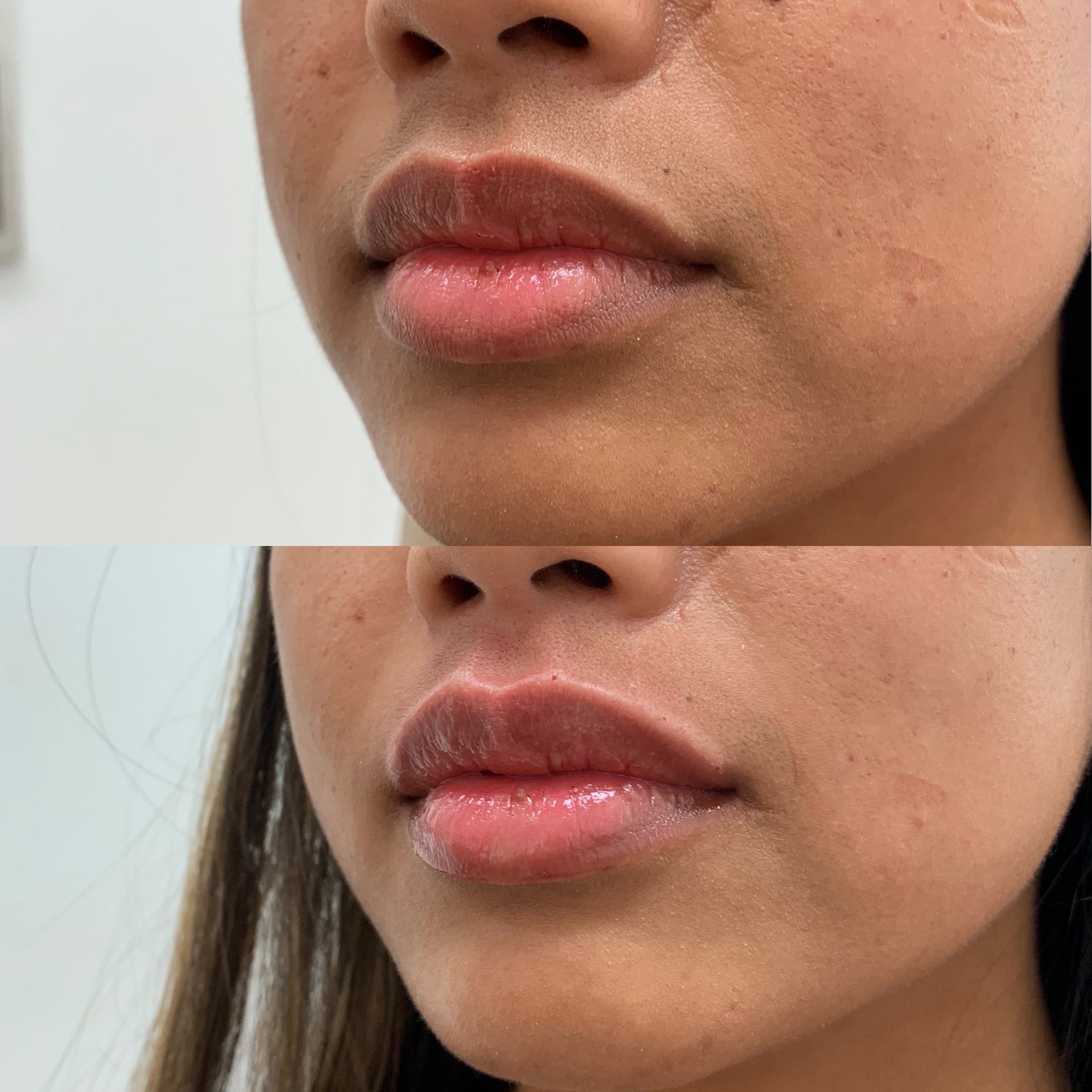 Before and After Lip lines Treatment | Beauty Boost Med Spa in Newport Beach, CA