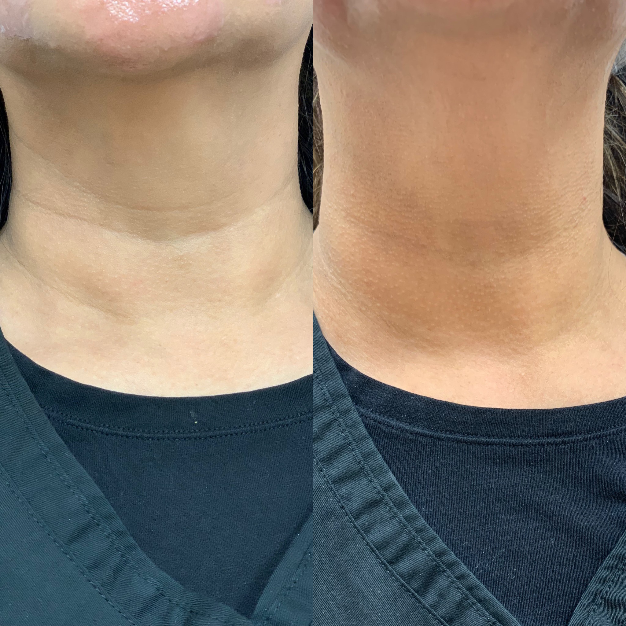 Before and After Necklines Treatment | Beauty Boost Med Spa in Newport Beach, CA