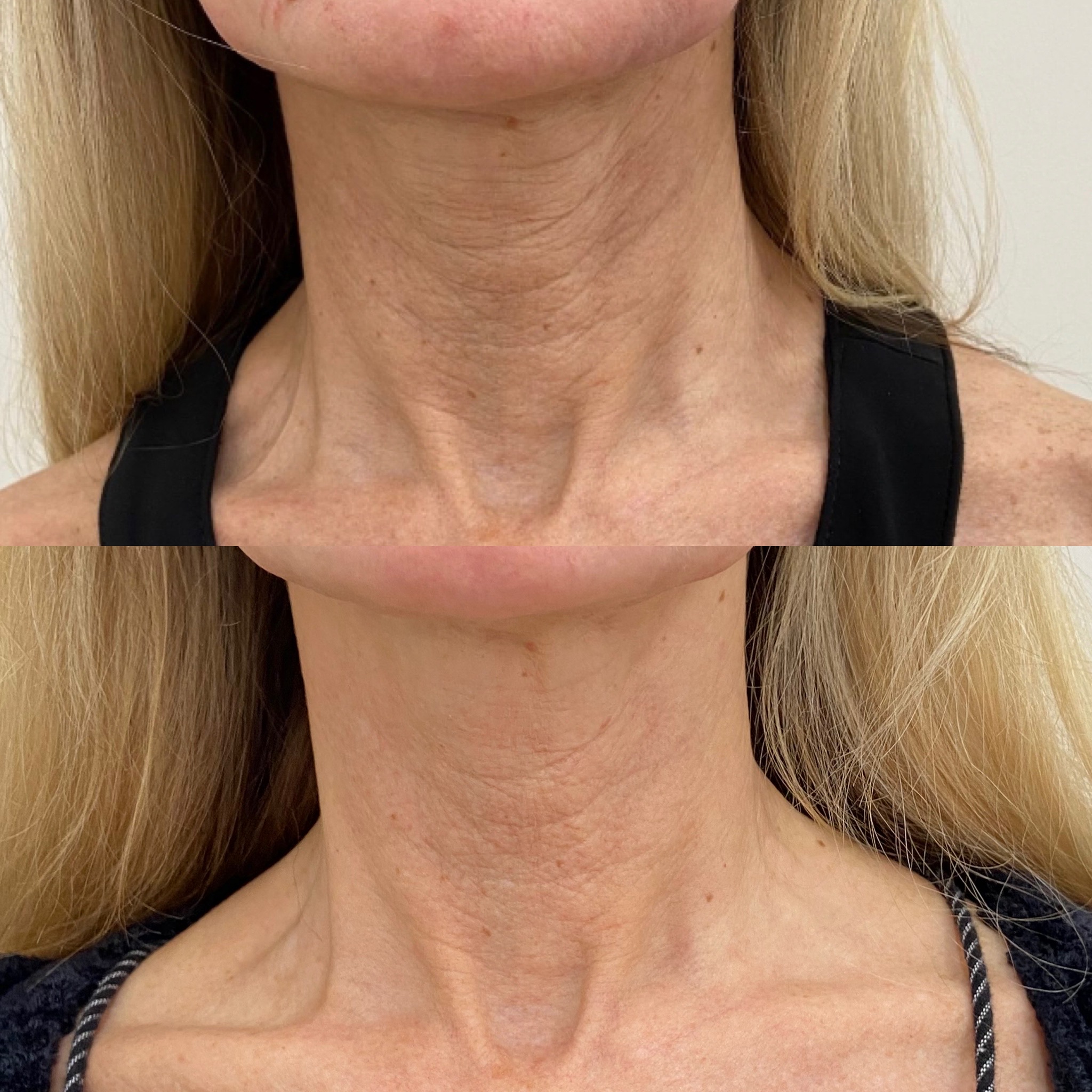 Before and After Botox treatment on Neck | Beauty Boost Med Spa in Newport Beach, CA