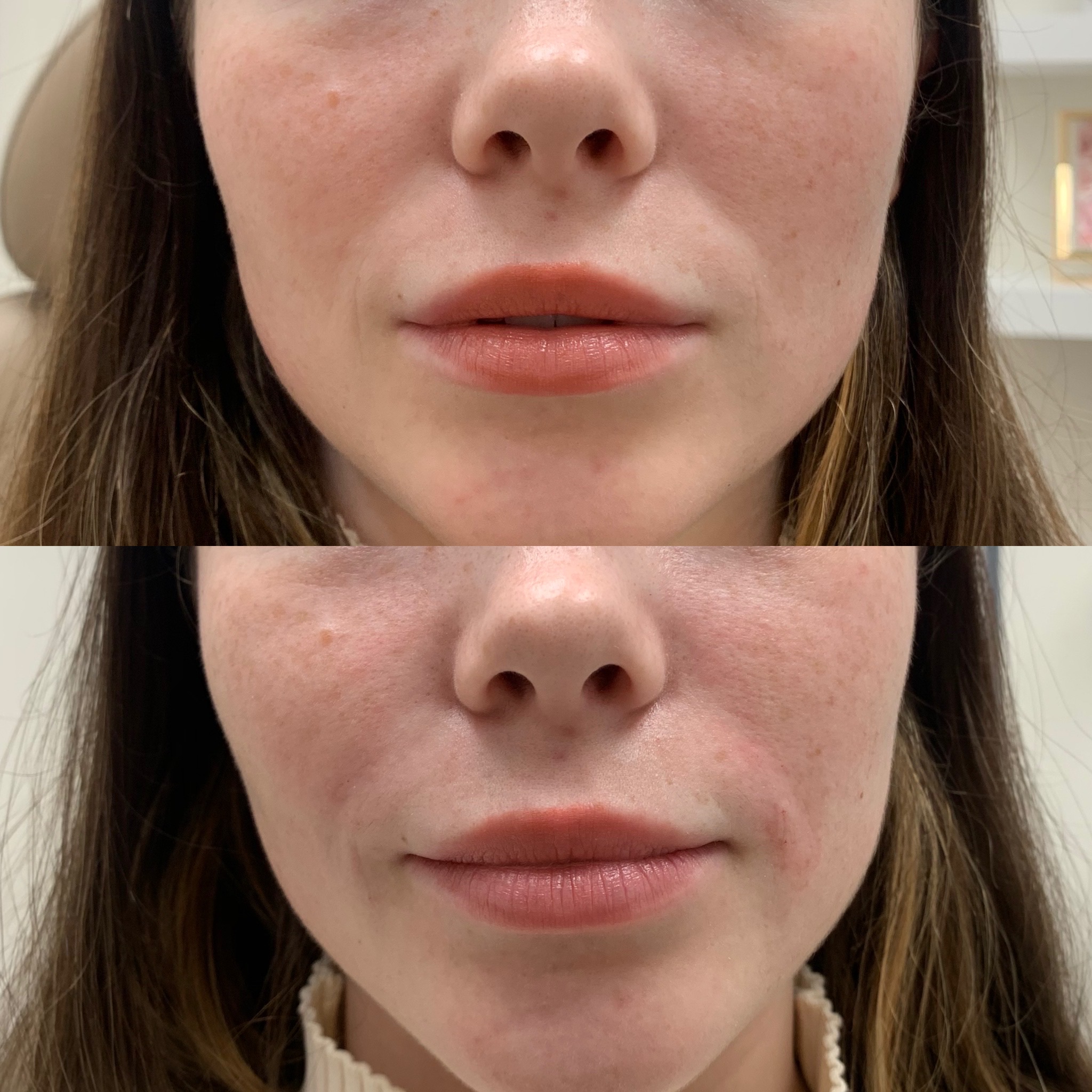 Before and After Smile Lines Treatment | Beauty Boost Med Spa in Newport Beach, CA