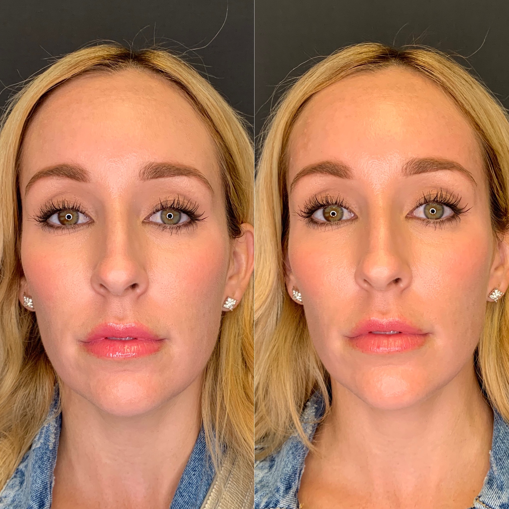 Before and After Temple Fillers Treatment | Beauty Boost Med Spa in Newport Beach, CA