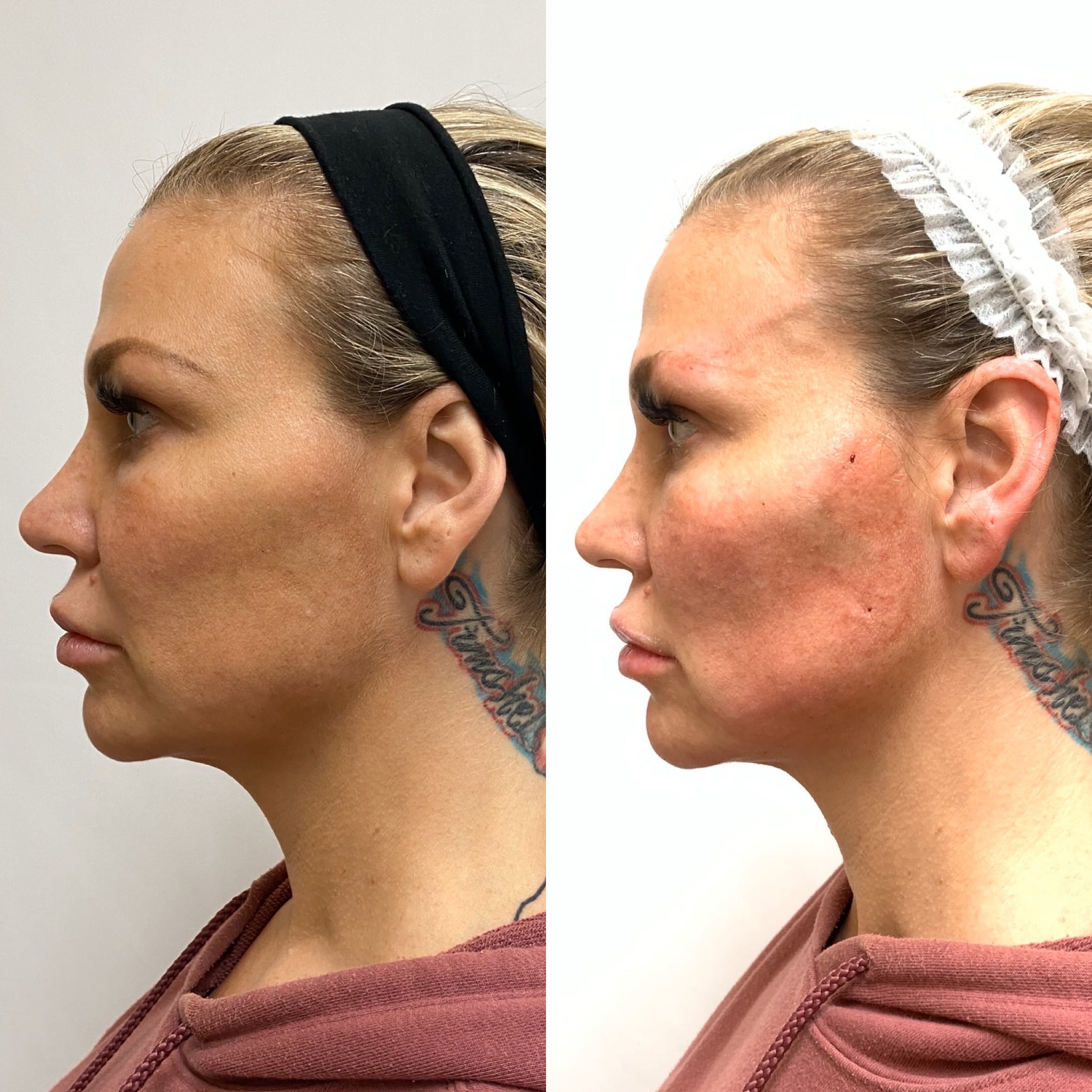 Before and After PDO Threads treatment | Beauty Boost Med Spa at Newport Beach, CA