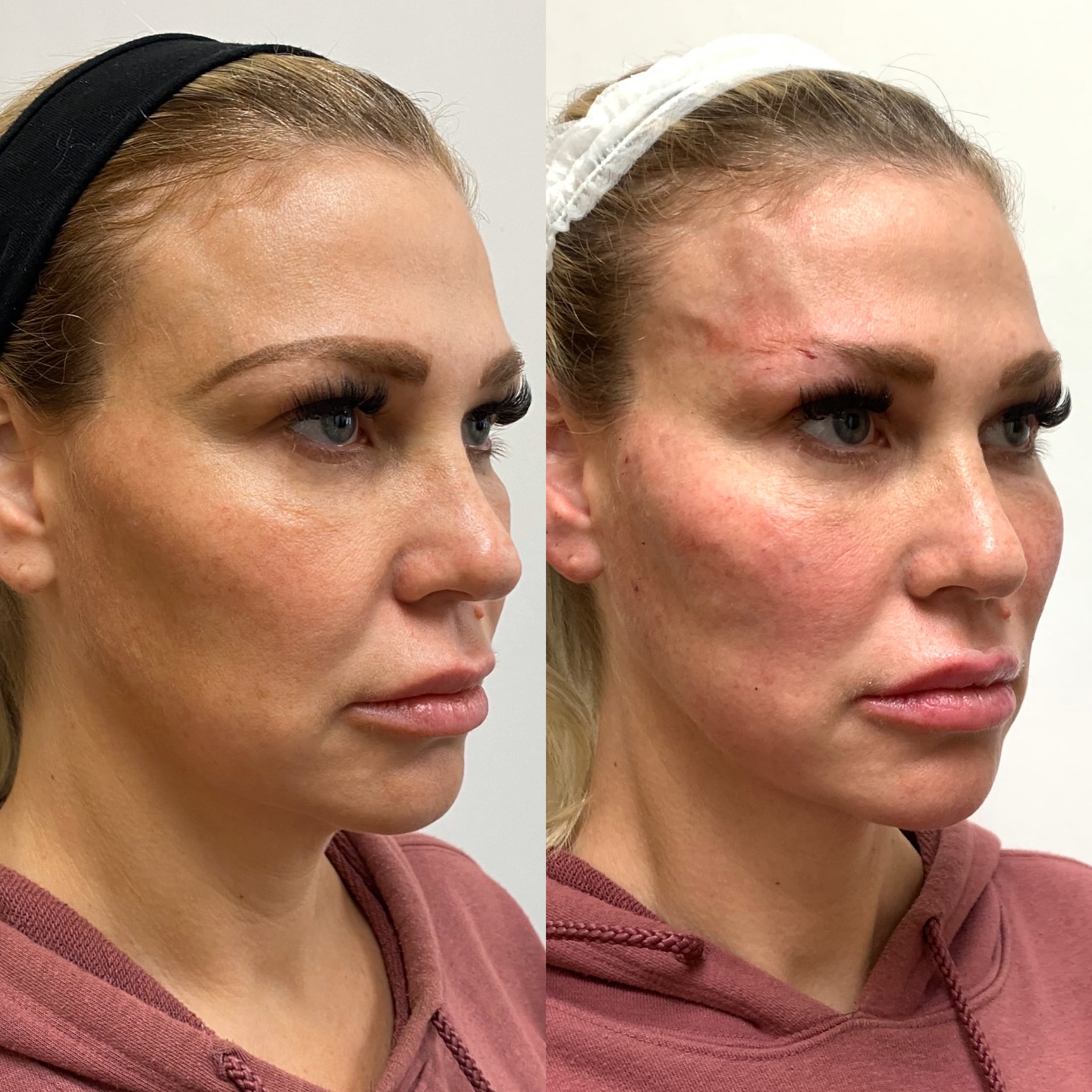 Before and After PDO Threads treatment | Beauty Boost Med Spa at Newport Beach, CA
