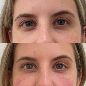 Before and After Undereyes Treatment | Beauty Boost Med Spa in Newport Beach, CA