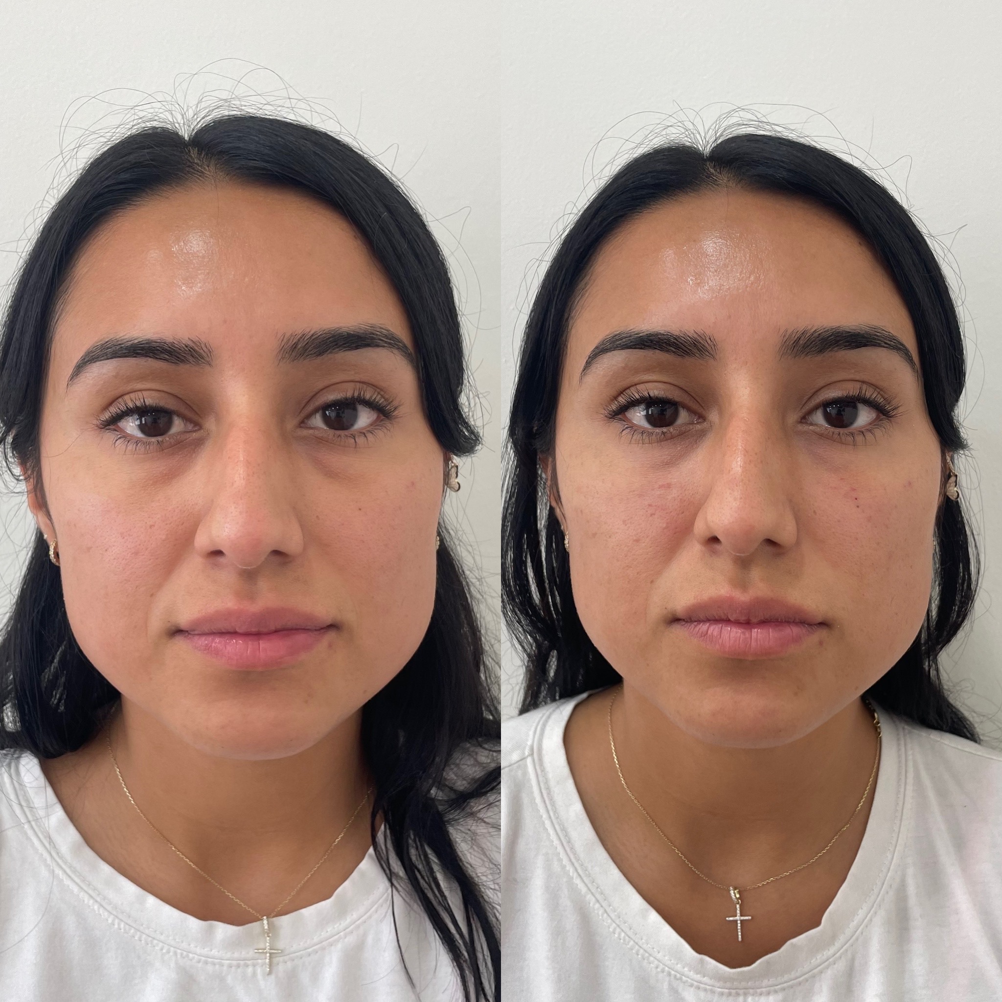 Before and After Undereyes Treatment | Beauty Boost Med Spa in Newport Beach, CA