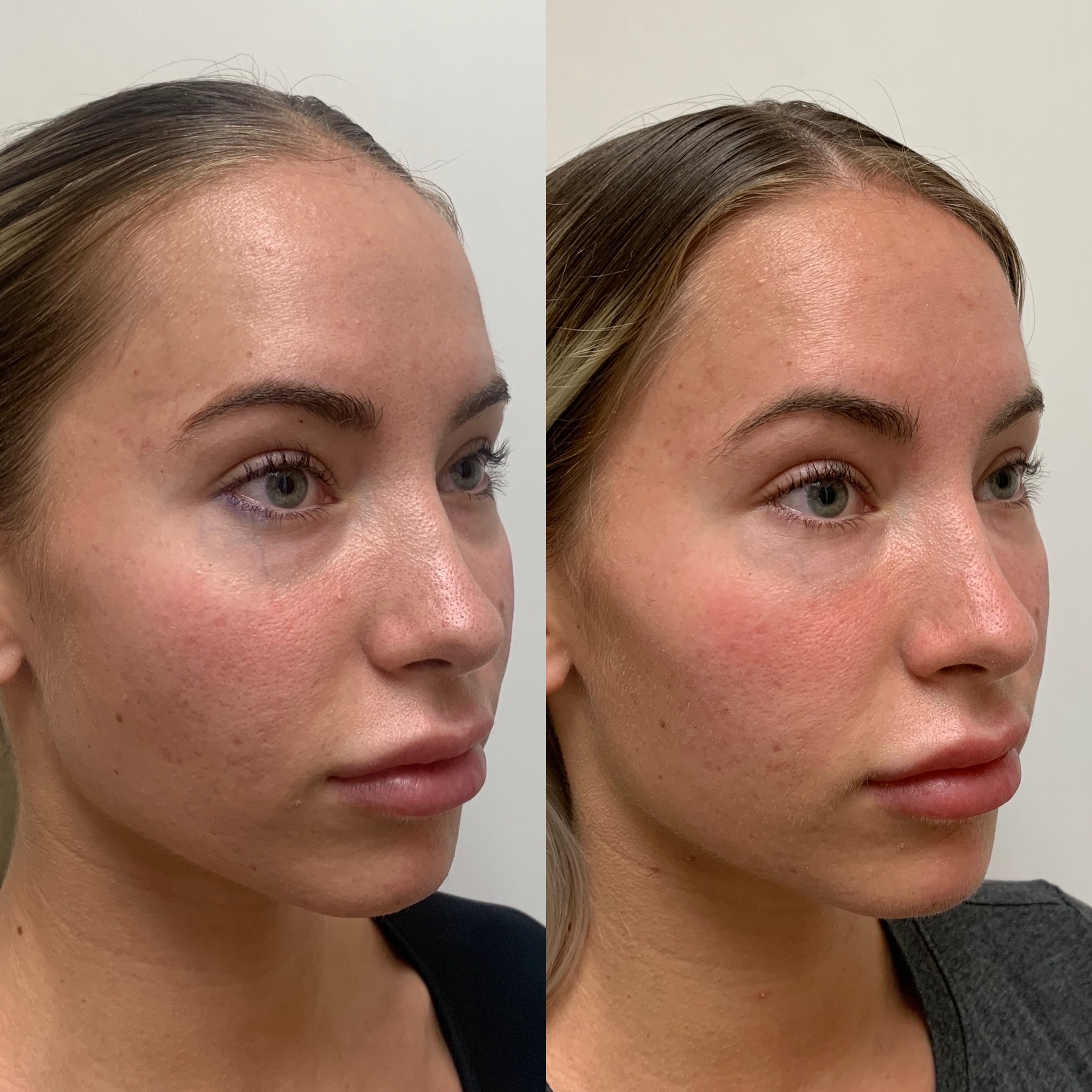 Before and After Fillers Treatment on Lips | Beauty Boost Med Spa in Newport Beach, CA