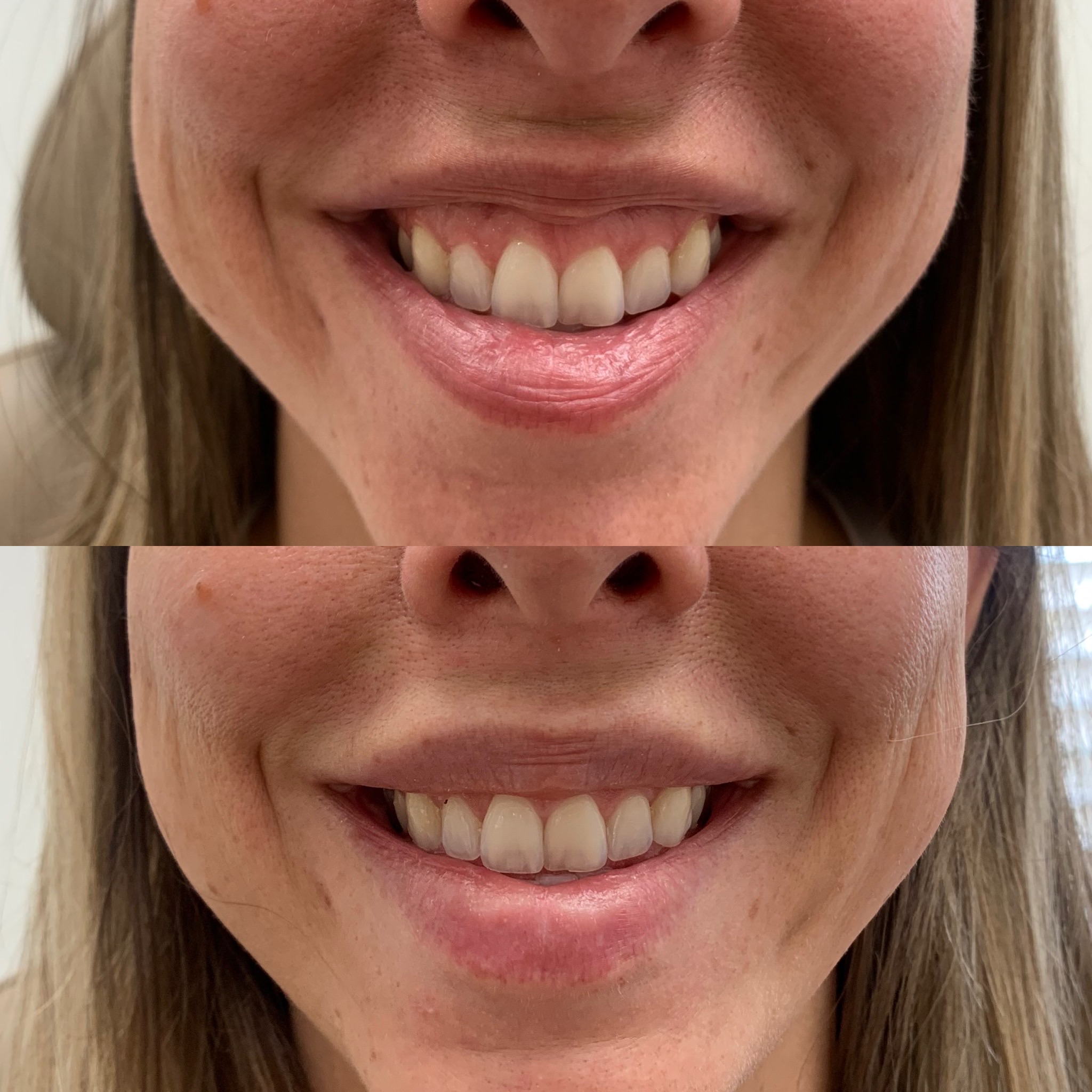 Before and After Botox Treatment on Lip Lines | Beauty Boost Med Spa in Newport Beach, CA
