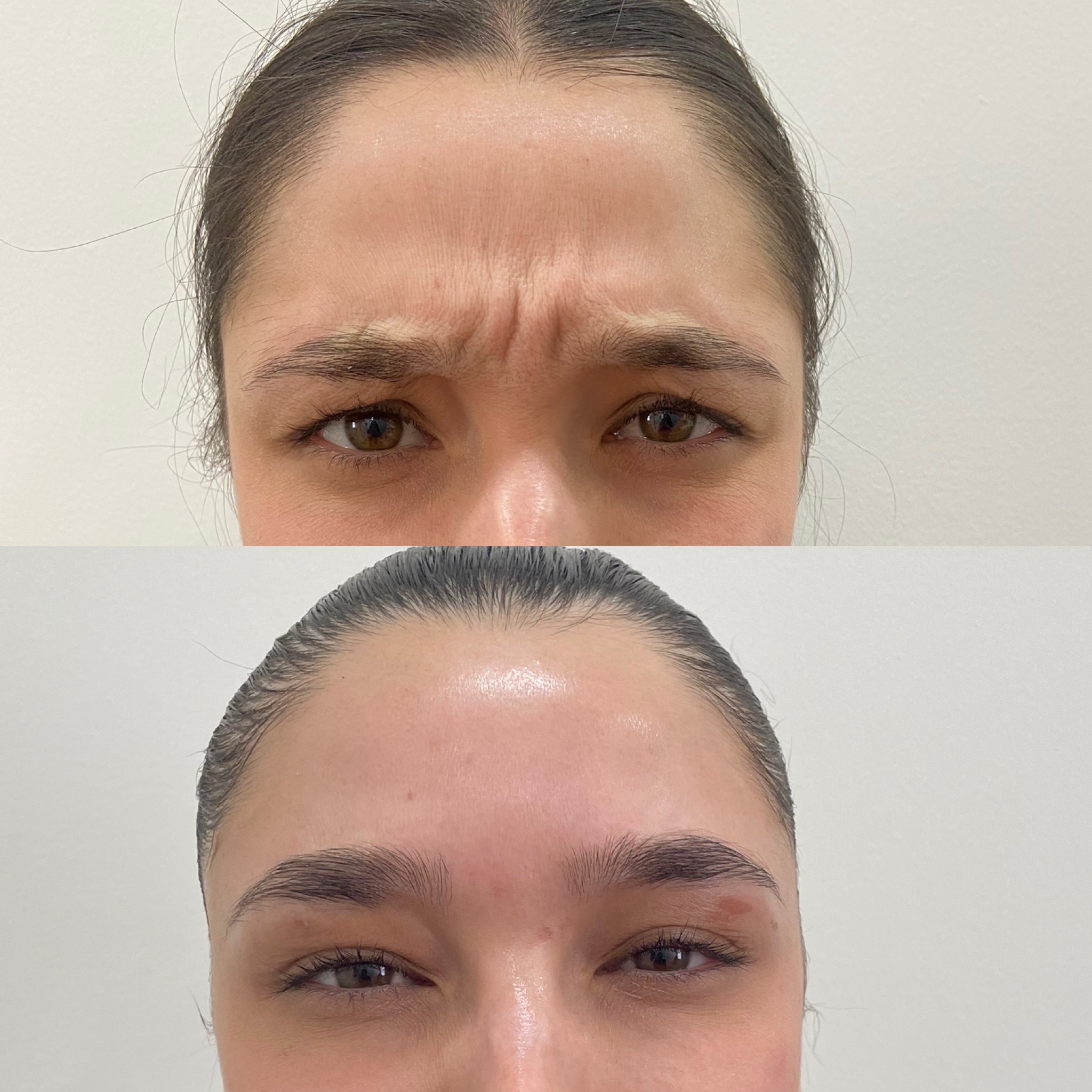Before and After Botox Treatment | Beauty Boost Med Spa in Newport Beach, CA