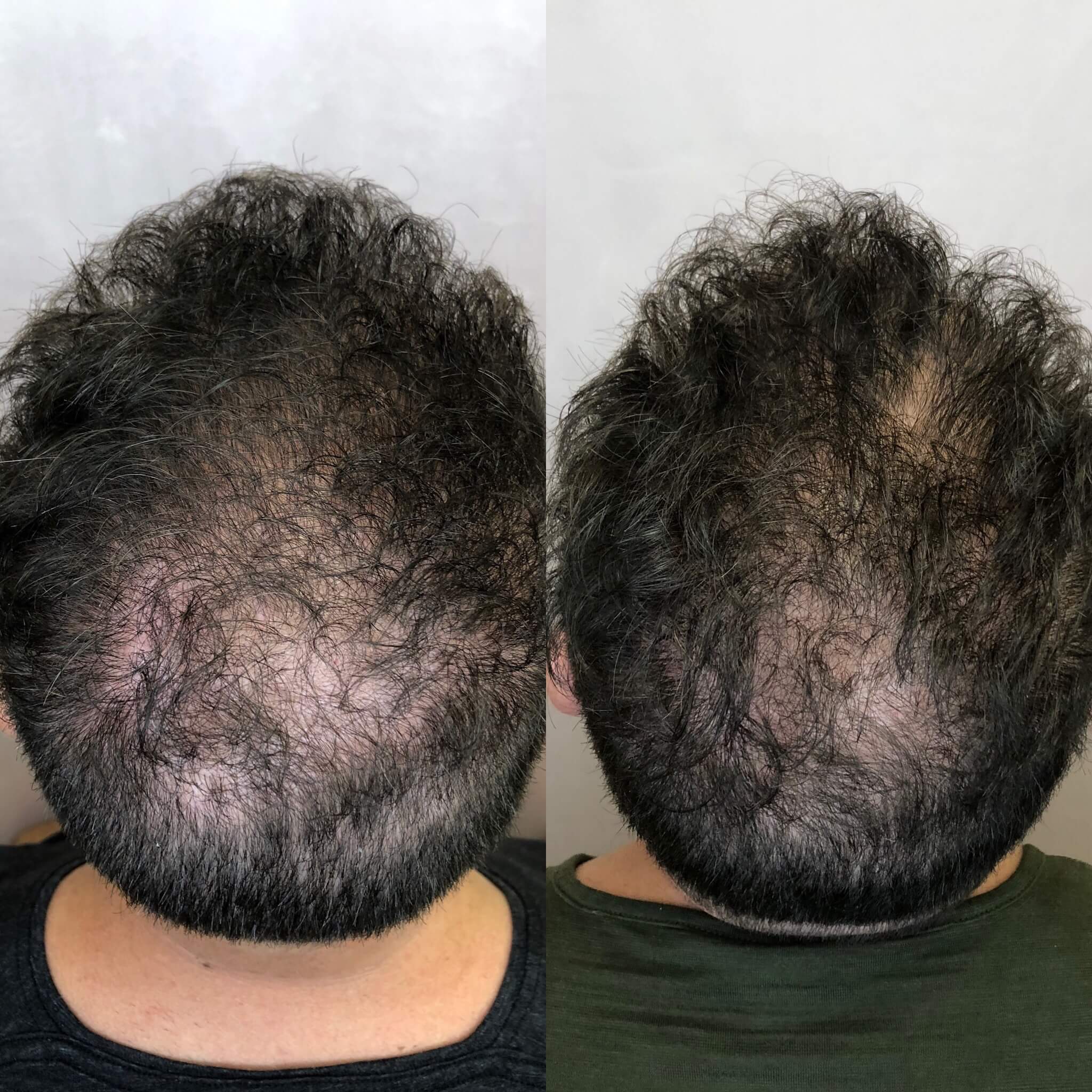 Before and After PRP Hair Restoration Treatment | Beauty Boost Med Spa in Newport Beach, CA