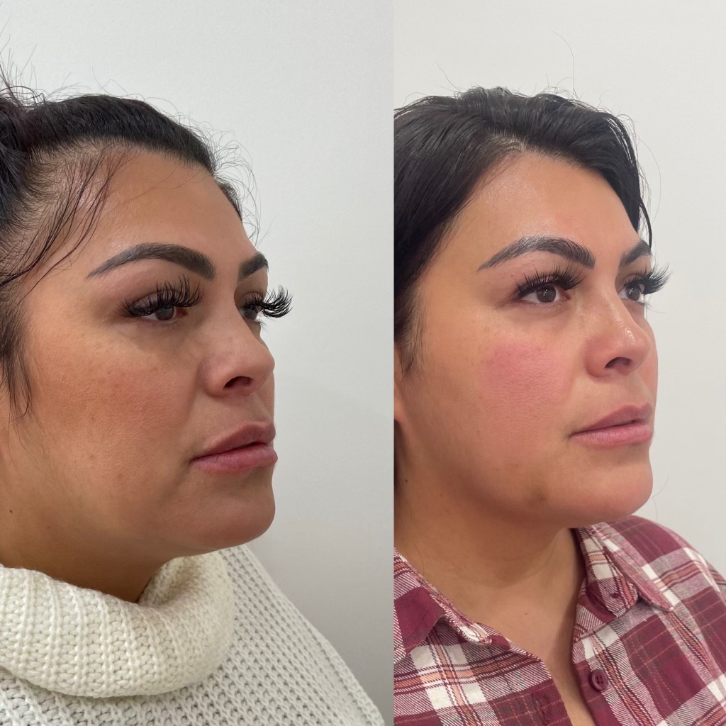 Before and After Kybella Treatment | Beauty Boost Med Spa in Newport Beach, CA