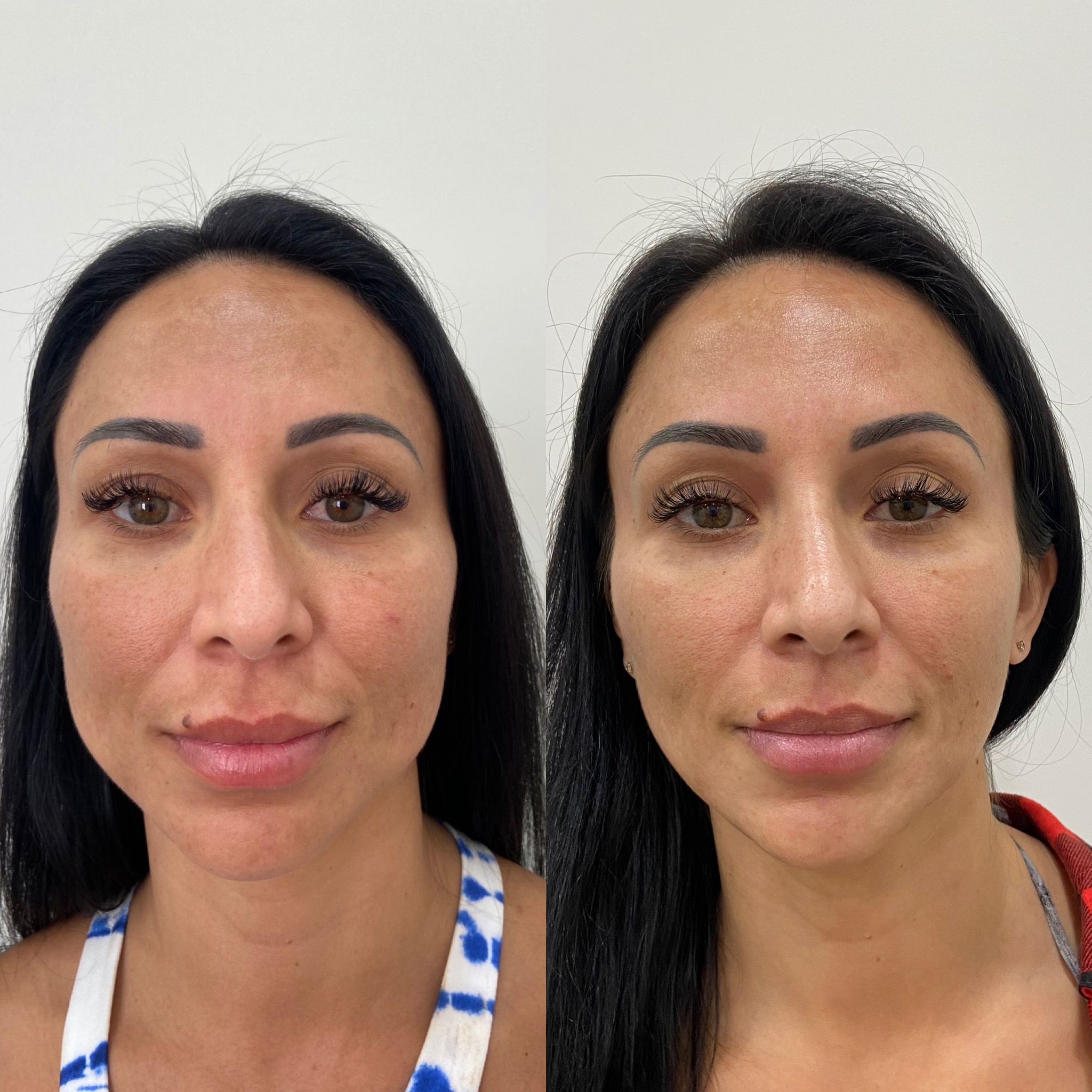 Before and After Skincare Treatment | Beauty Boost Med Spa in Newport Beach, CA