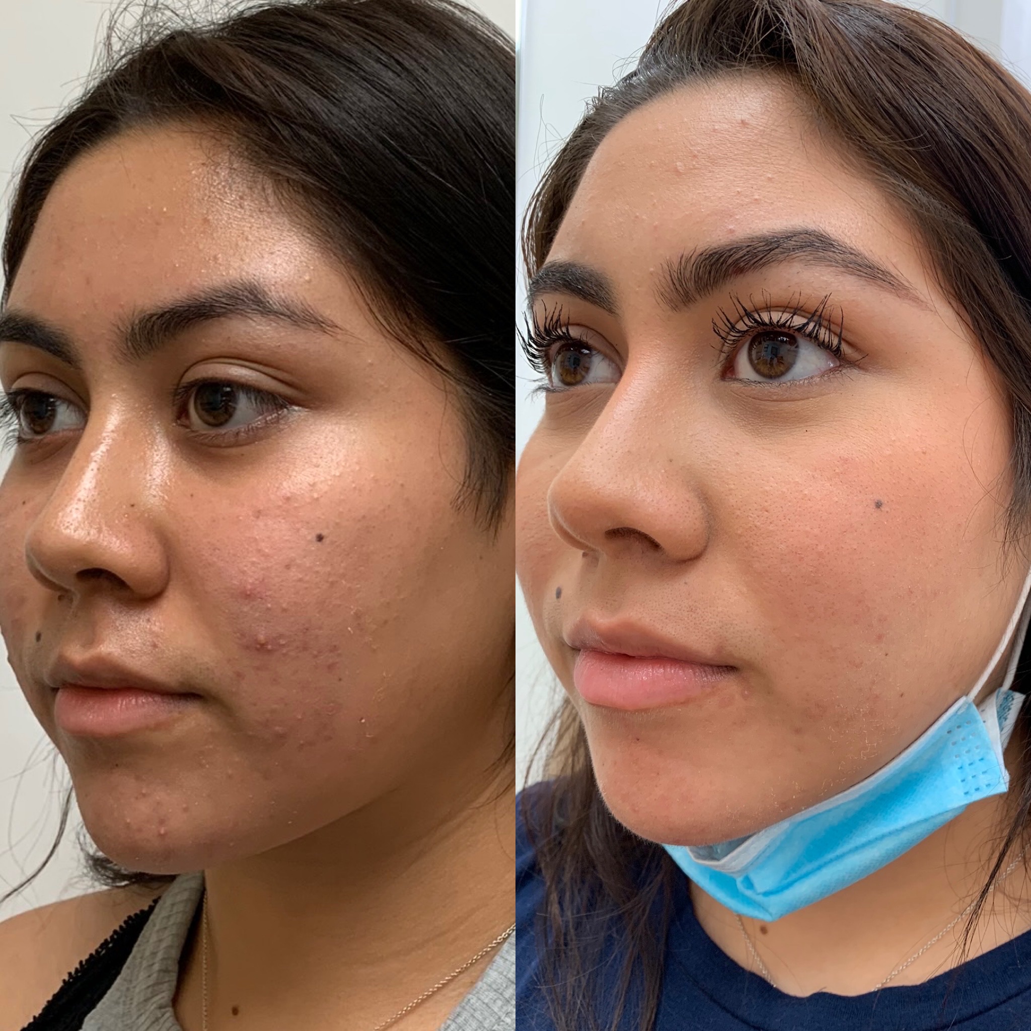 Before and After Skincare Treatment | Beauty Boost Med Spa in Newport Beach, CA