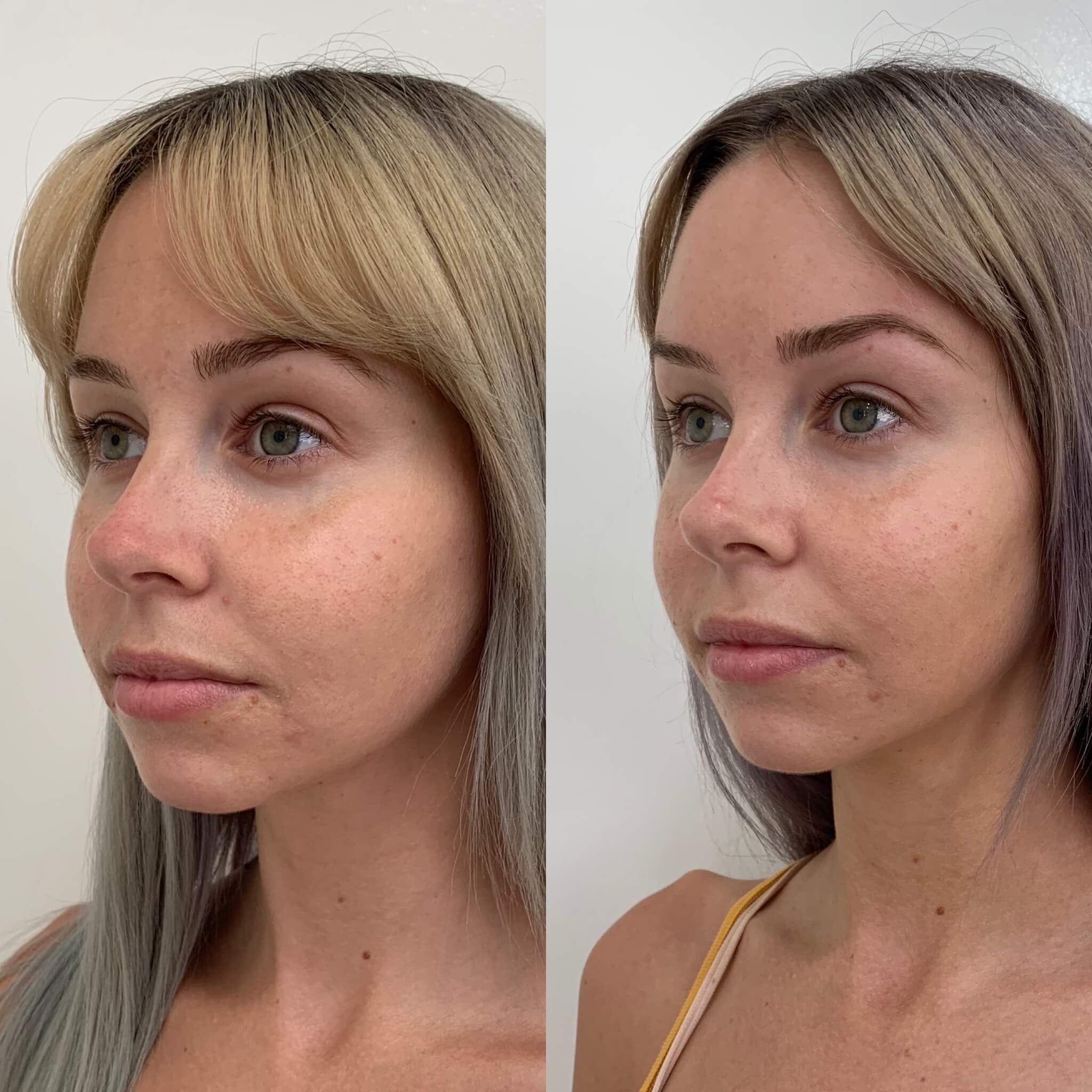 Before and After PDO Thread lift Treatment | Beauty Boost Med Spa in Newport Beach, CA