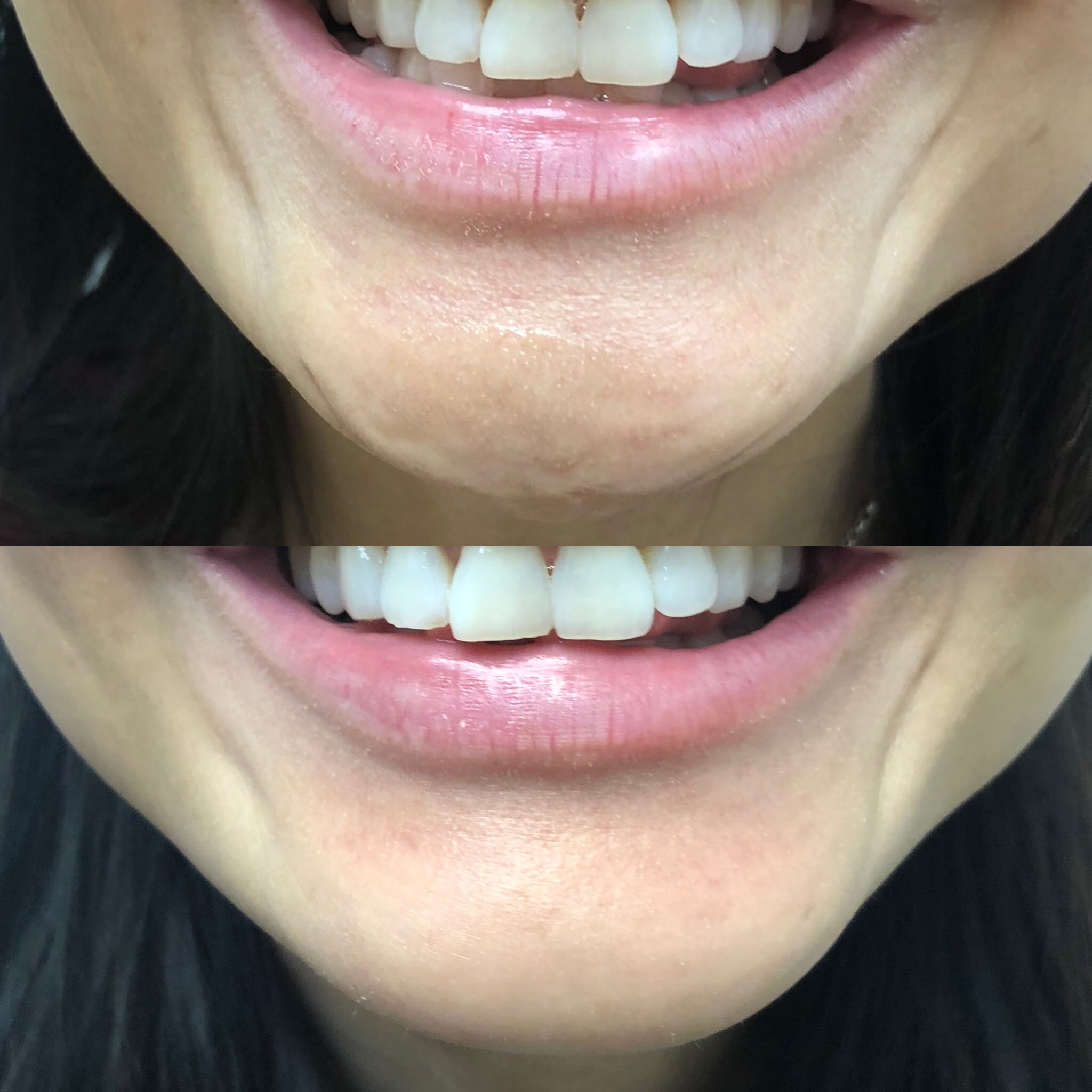 Before and After Botox Dao Chin treatment | Beauty Boost Med Spa in Newport Beach, CA