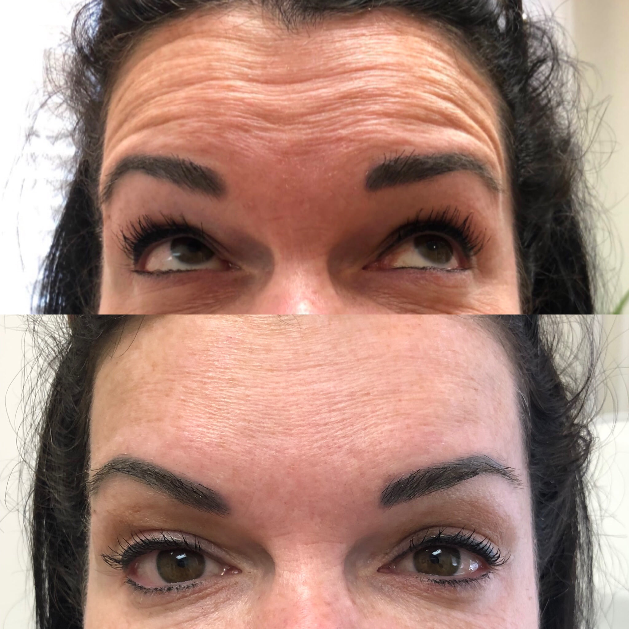 Before and After Botox Frown-fh Treatment | Beauty Boost Med Spa in Newport Beach, CA