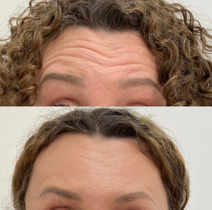Before and After Botox Frown-fh Treatment | Beauty Boost Med Spa in Newport Beach, CA