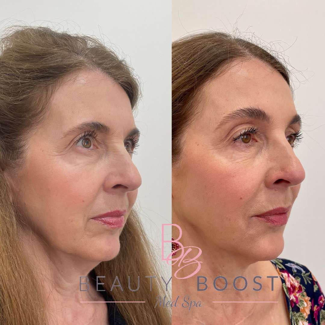 Before and After full face boost treatment in Beauty Boost Med Spa at Newport Beach, CA