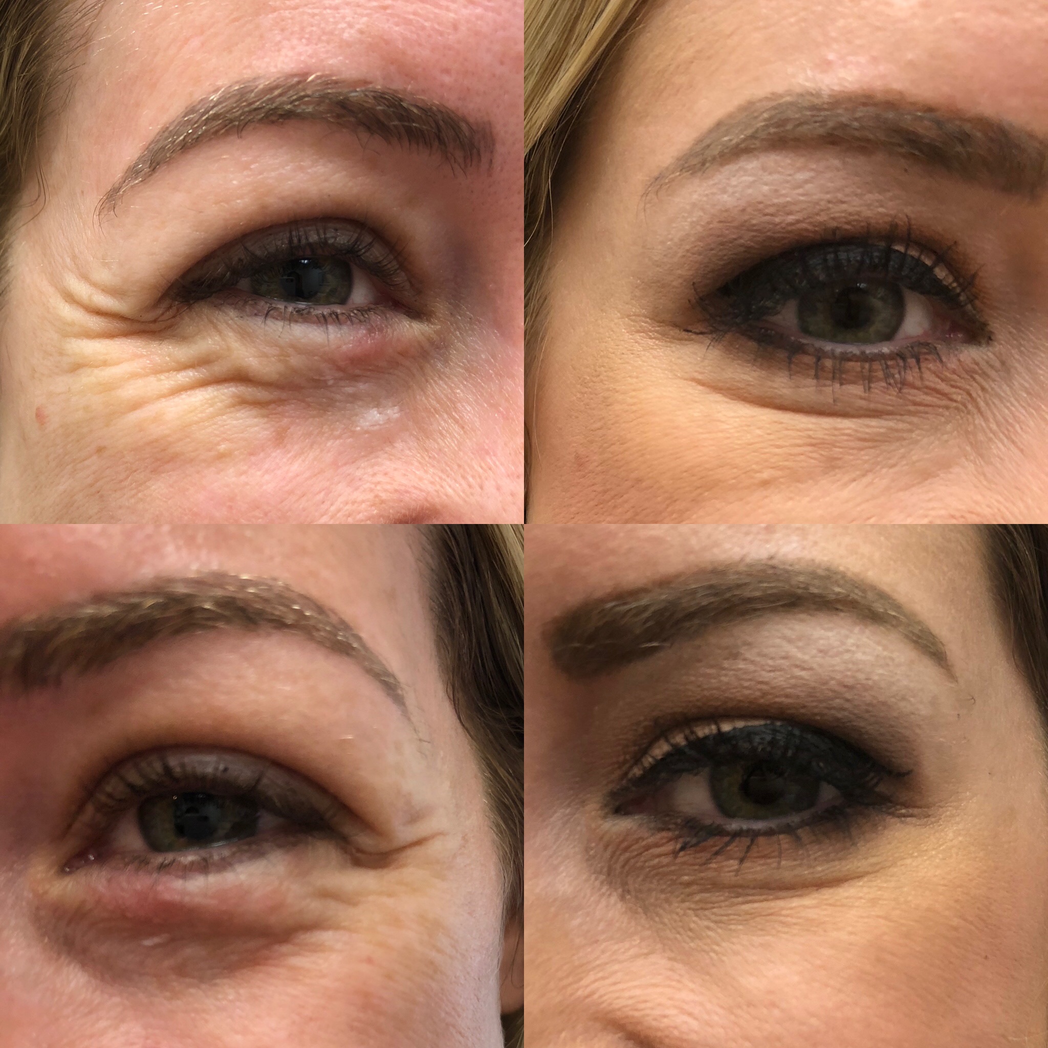 Before and After Botox Jelly Roll Treatment | Beauty Boost Med Spa in Newport Beach, CA