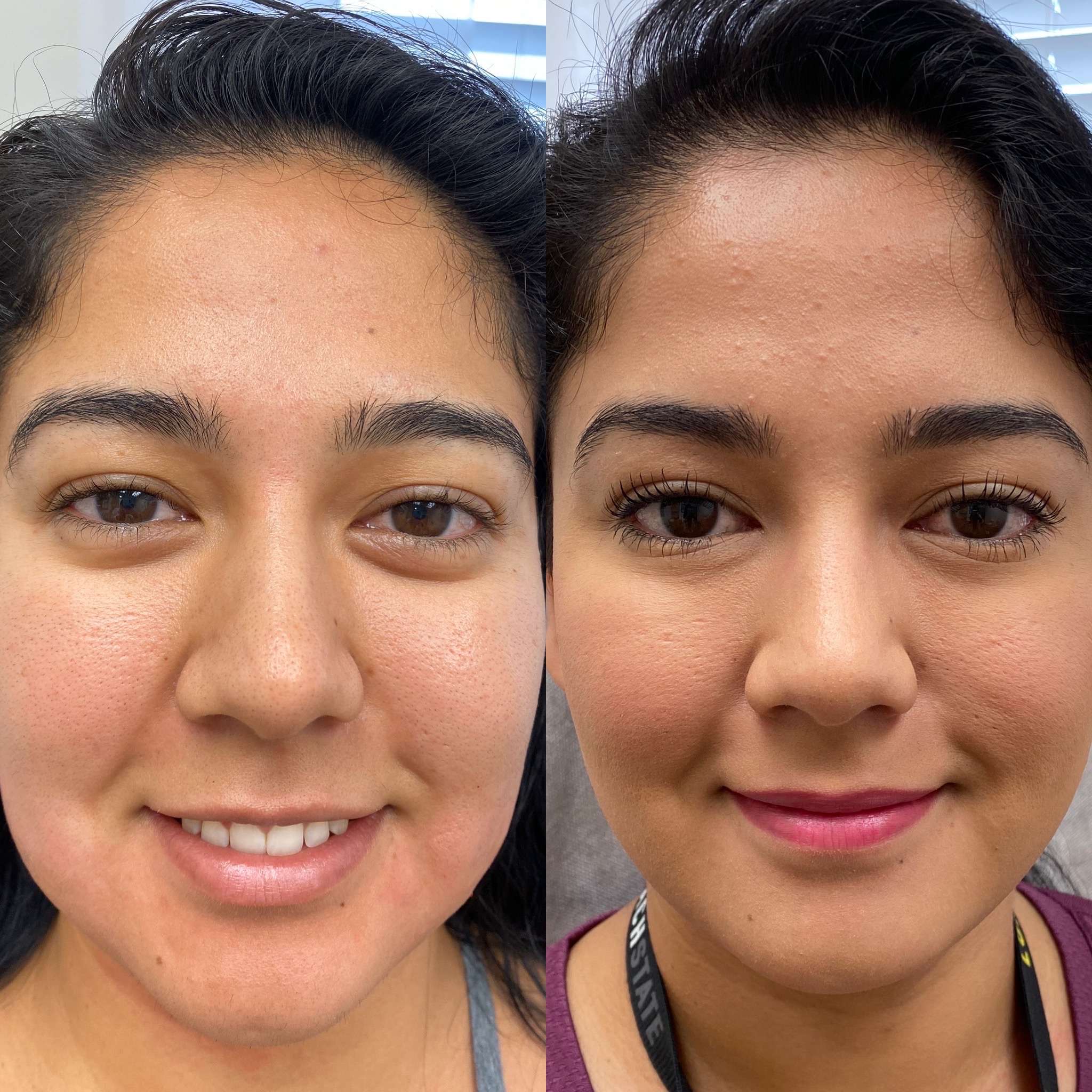 Before and After Botox Jelly Roll Treatment | Beauty Boost Med Spa in Newport Beach, CA