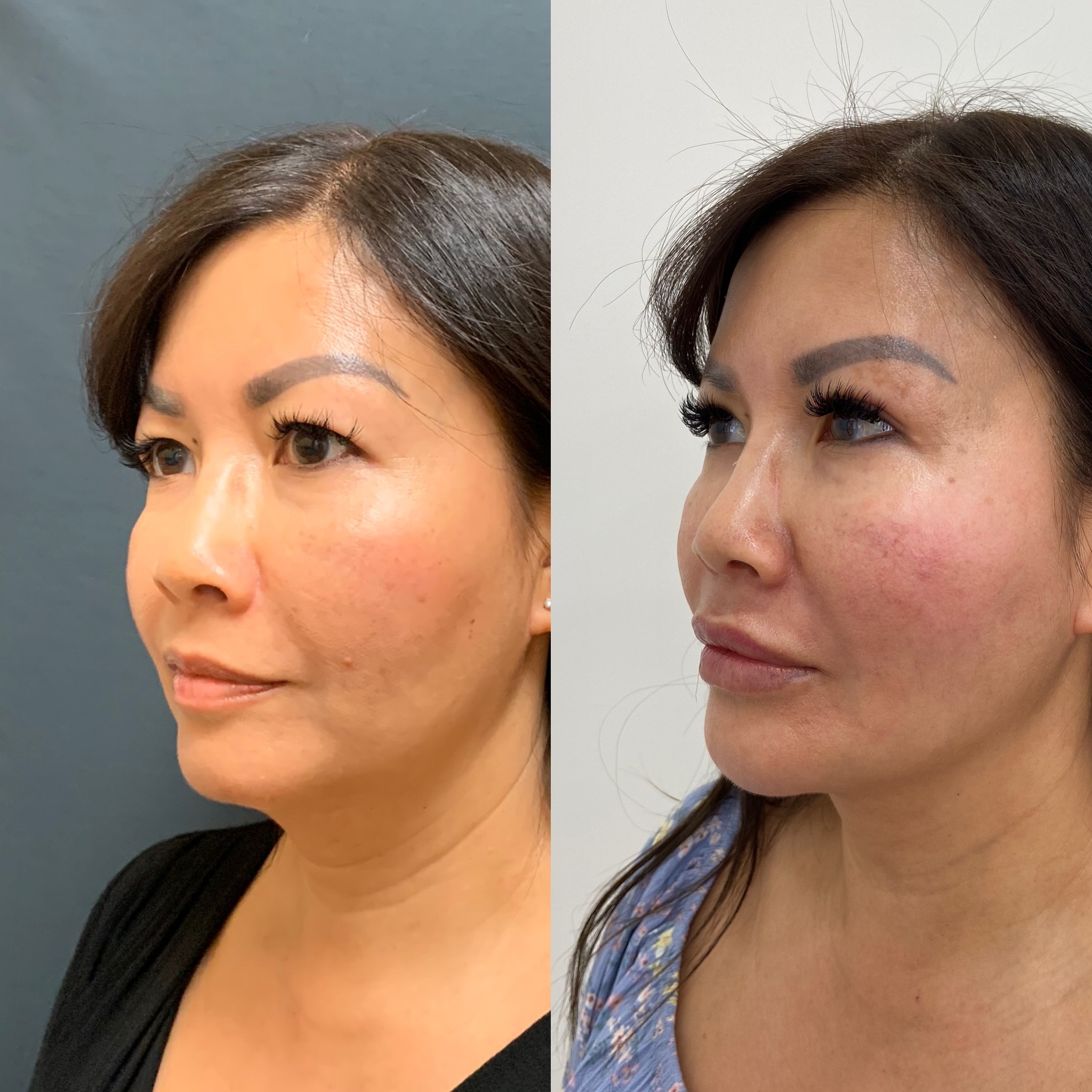 Before and After Kybella Treatment | Beauty Boost Med Spa in Newport Beach, CA