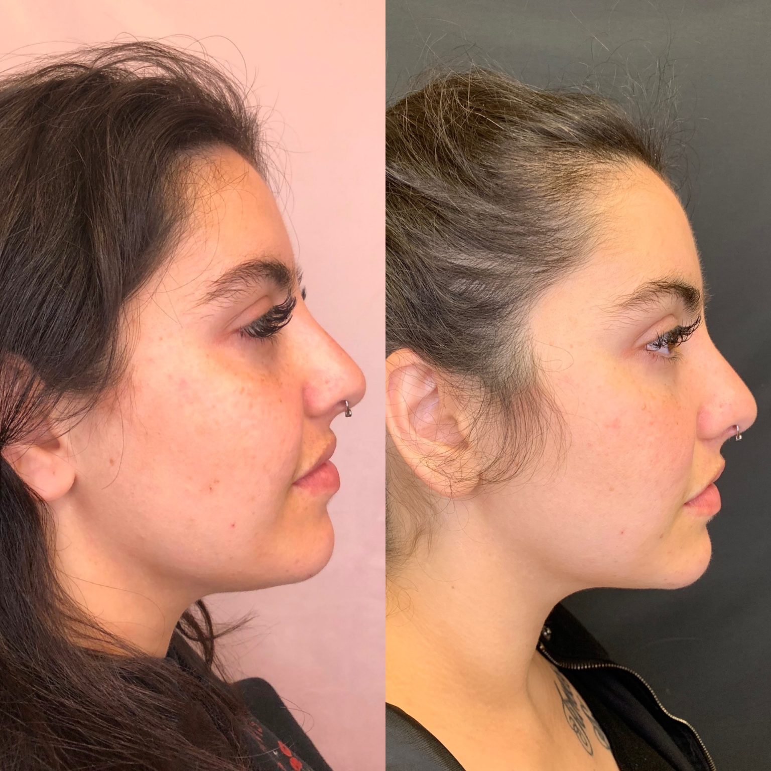 Kybella Before And After Images | Beauty Boost Med Spa