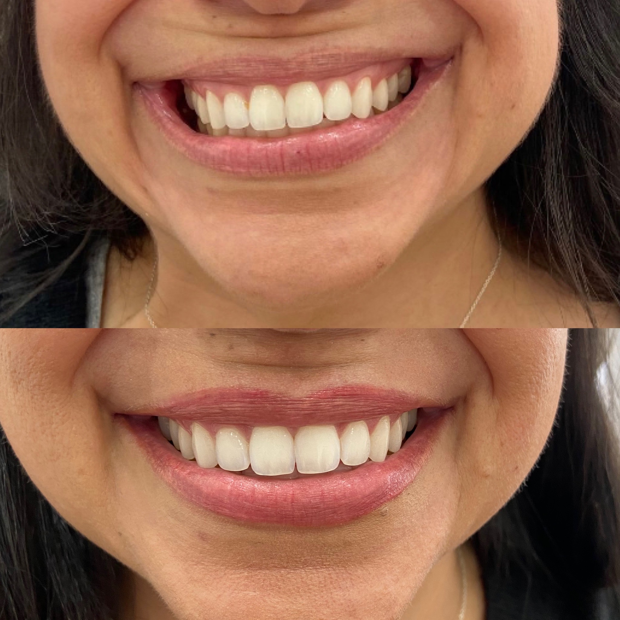 Before and After Lip lines flip Treatment | Beauty Boost Med Spa in Newport Beach, CA