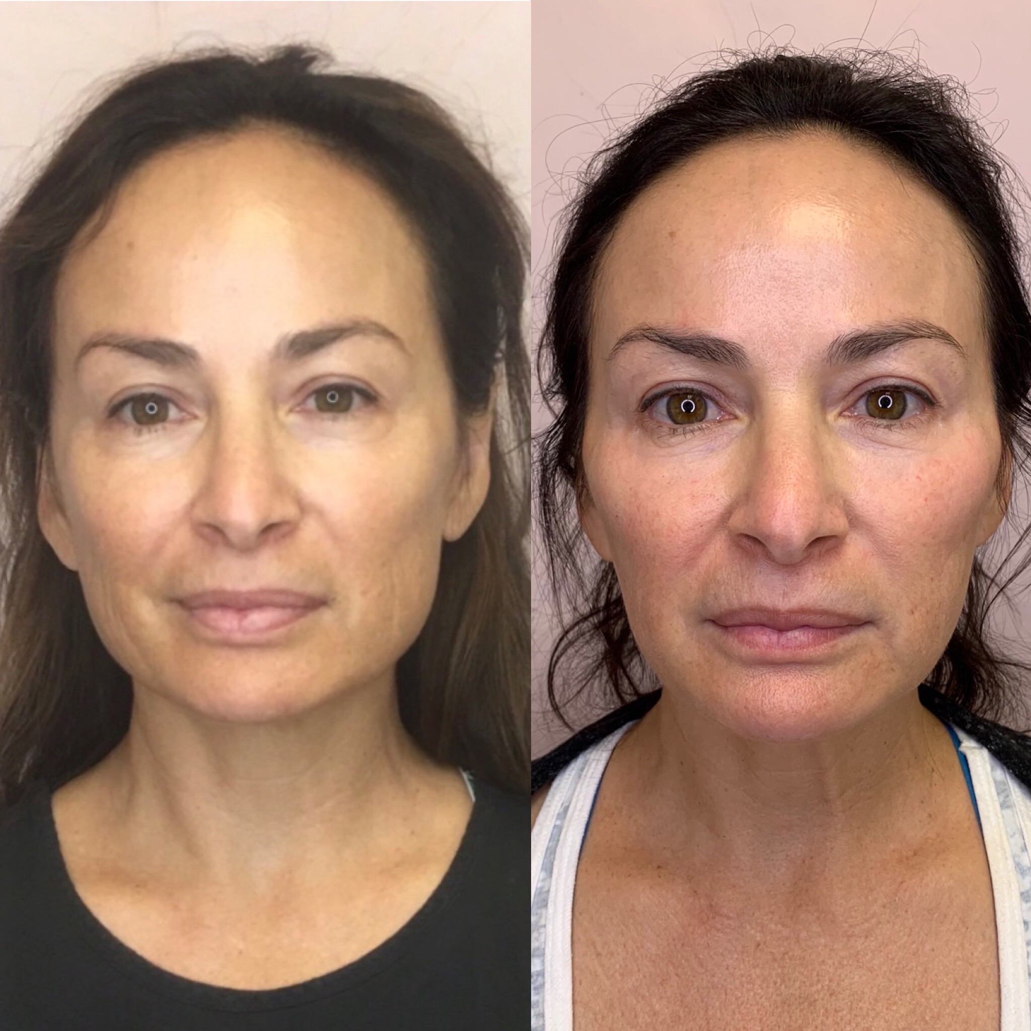 Before and After Botox Masseters Treatment | Beauty Boost Med Spa in Newport Beach, CA