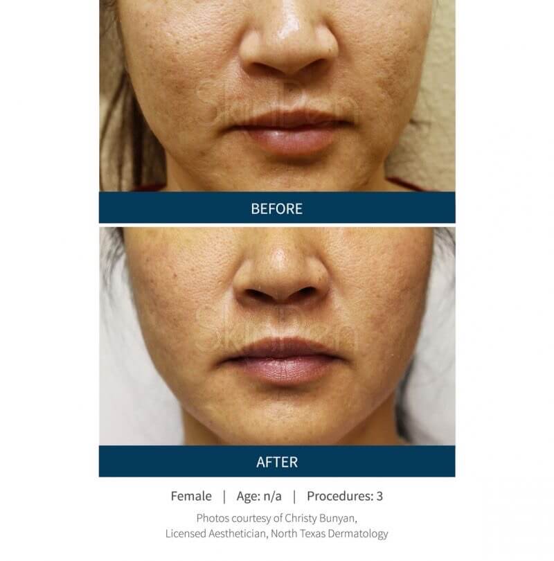 Before and After Microneedling PRP/PRF Treatment | Beauty Boost Med Spa in Newport Beach, CA