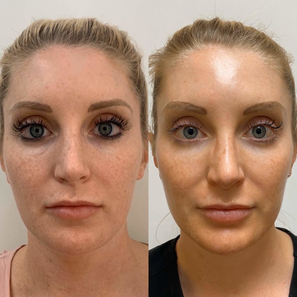 Before and After Microneedling PRP/PRF Treatment | Beauty Boost Med Spa in Newport Beach, CA
