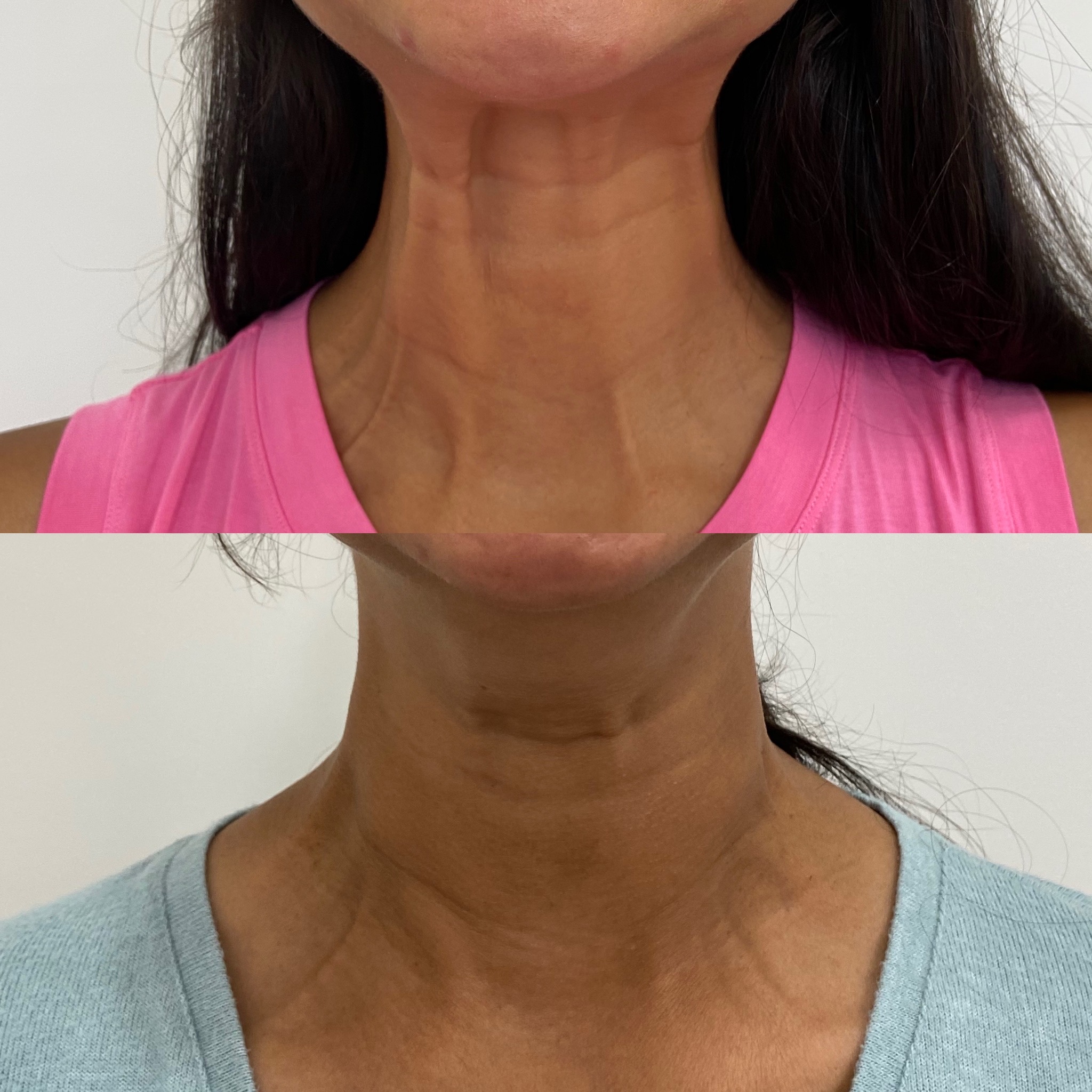 Before and After Treatment on Neck | Beauty Boost Med Spa in Newport Beach, CA