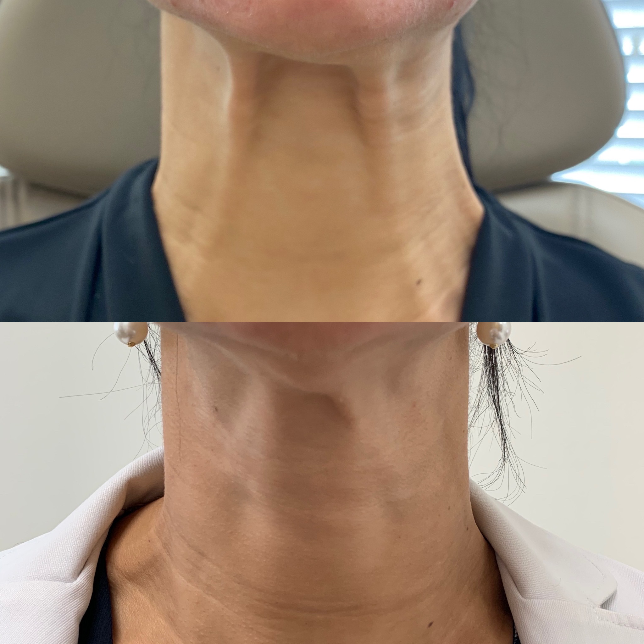 Before and After Treatment on Neck | Beauty Boost Med Spa in Newport Beach, CA