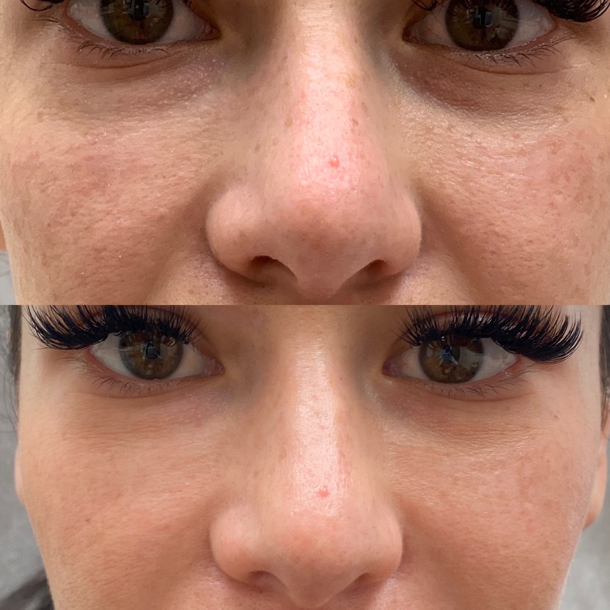 Before and After PRP/PRF Treatment | Beauty Boost Med Spa in Newport Beach, CA