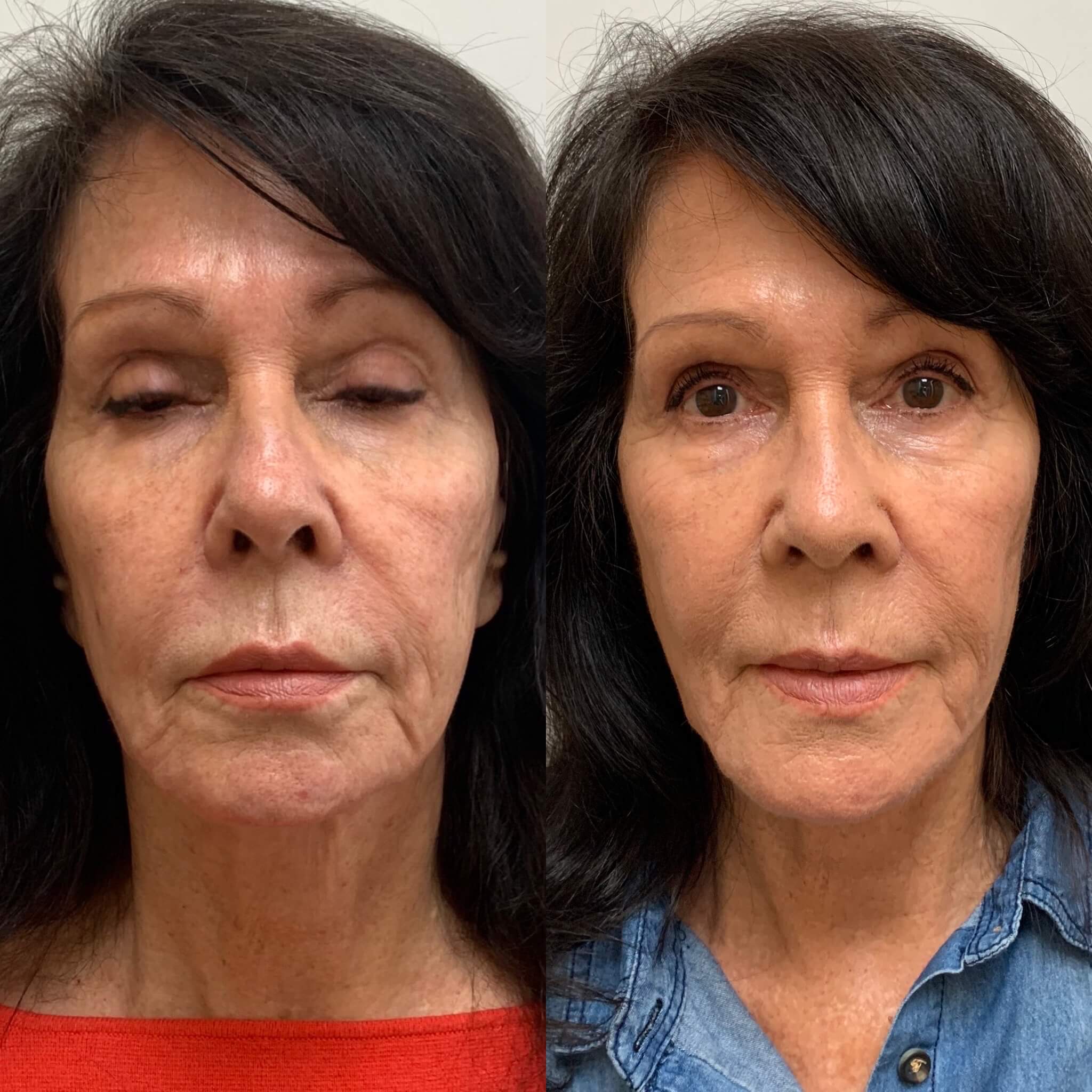 Before and After Sculptra treatment | Beauty Boost Med Spa at Newport Beach, CA