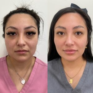 The Magic Of PRP: Before And After | Beauty Boost Med Spa