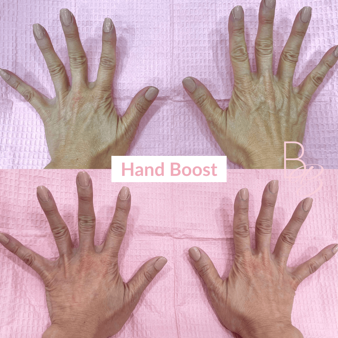 Before and After results of Hand Boost treatment | Beauty Boost Med Spa in Newport Beach, CA