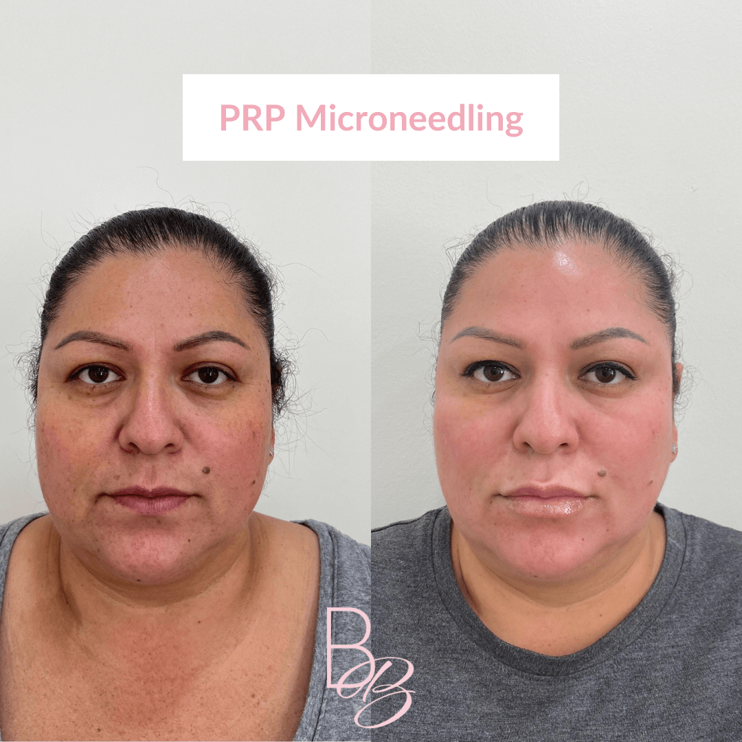 Before and After results of PRP Microneedling treatment | Beauty Boost Med Spa in Newport Beach, CA