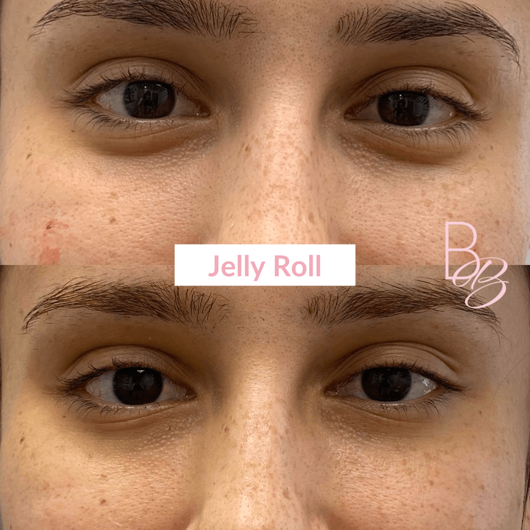 Before and After Jelly Roll Eye treatment result | Beauty Boost Med Spa in Newport Beach, CA