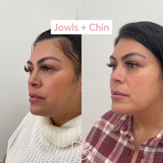 Before and After jowls and chin treatment result | Beauty Boost Med Spa in Newport Beach, CA