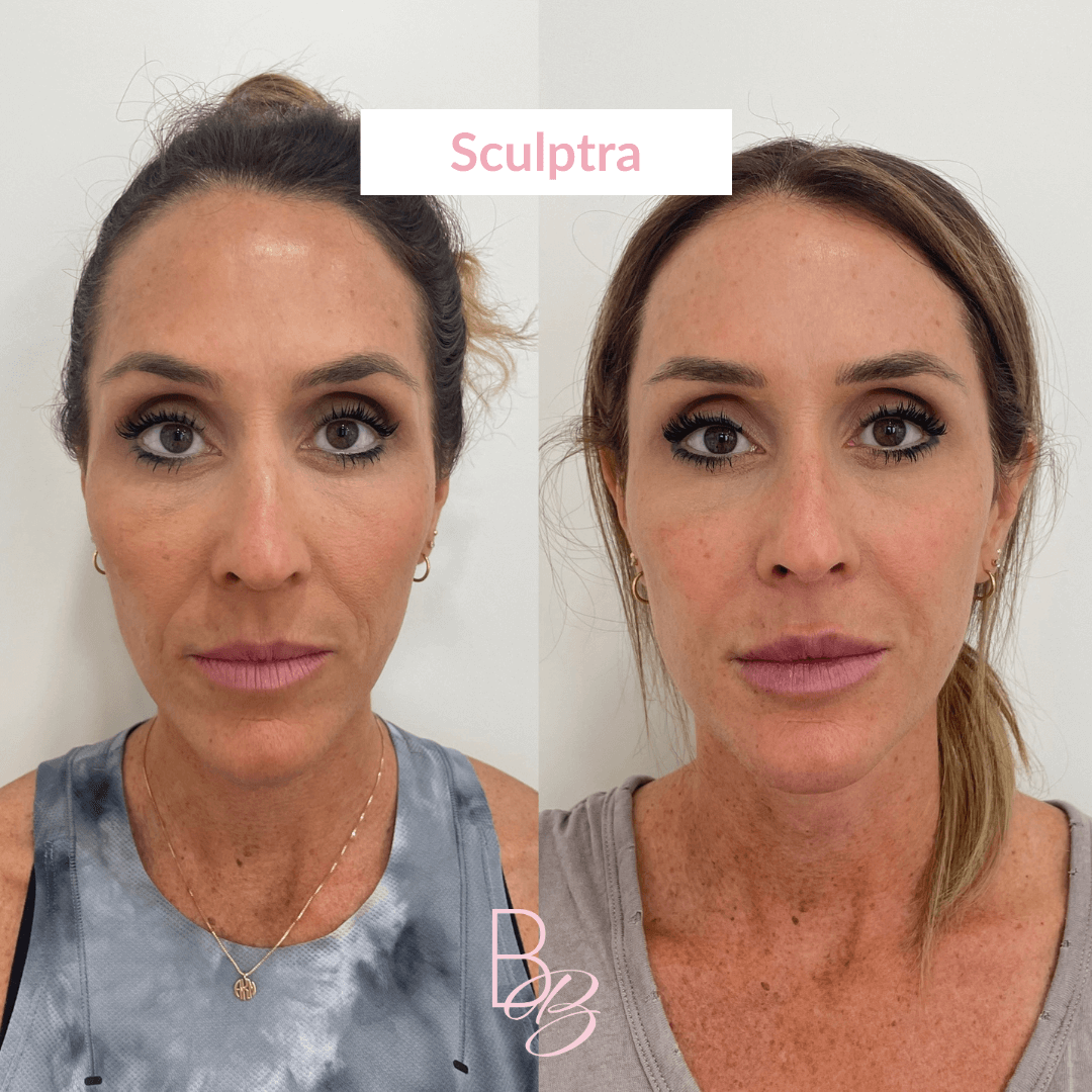 Before and After results of Sculptra treatment | Beauty Boost Med Spa in Newport Beach, CA