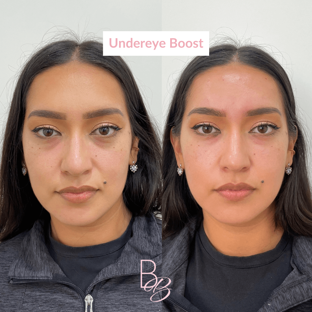 Before and After results of Undereye Boost treatment | Beauty Boost Med Spa in Newport Beach, CA